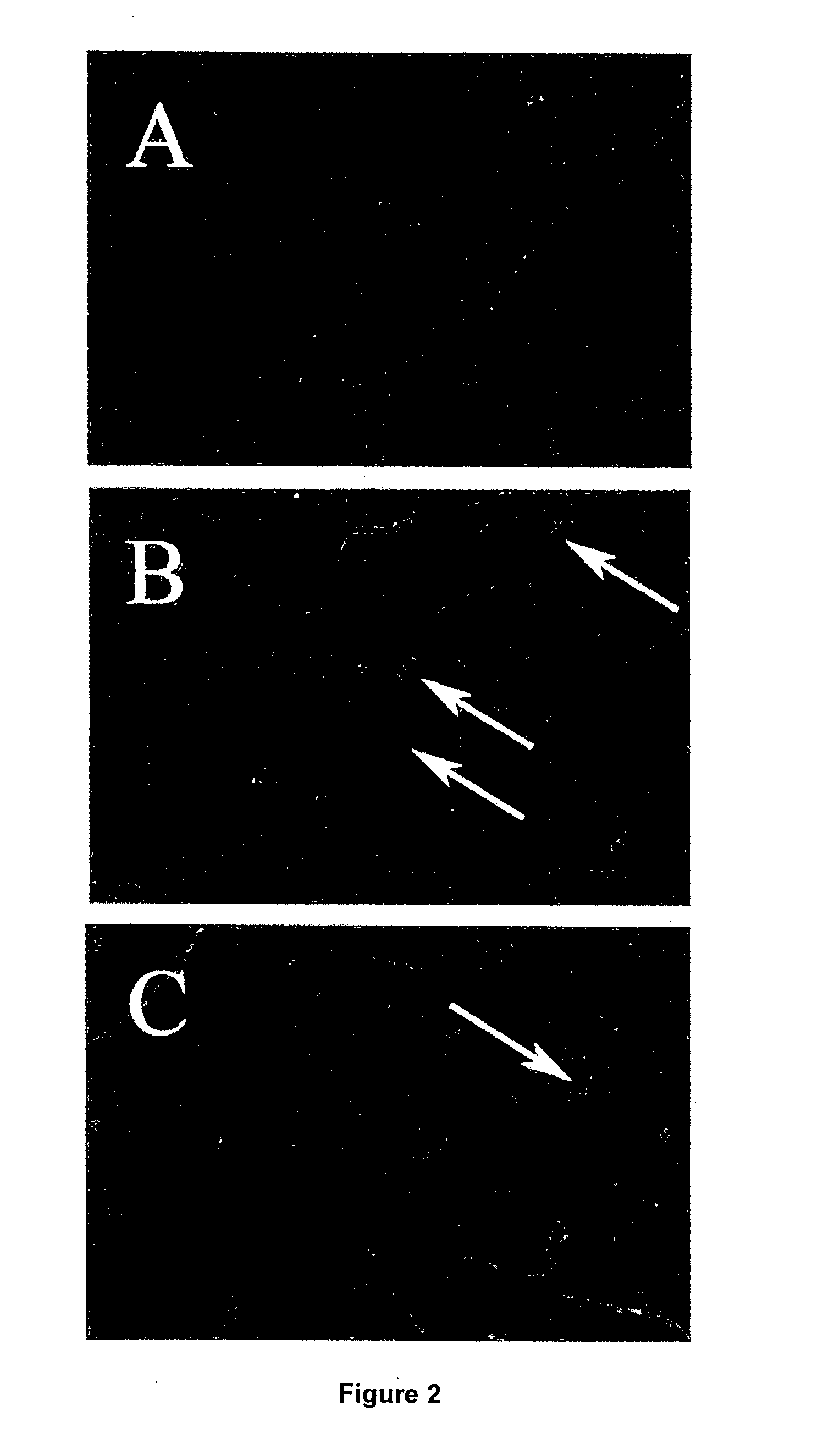 Methods of treating eye diseases associated with inflammation and vascular proliferation