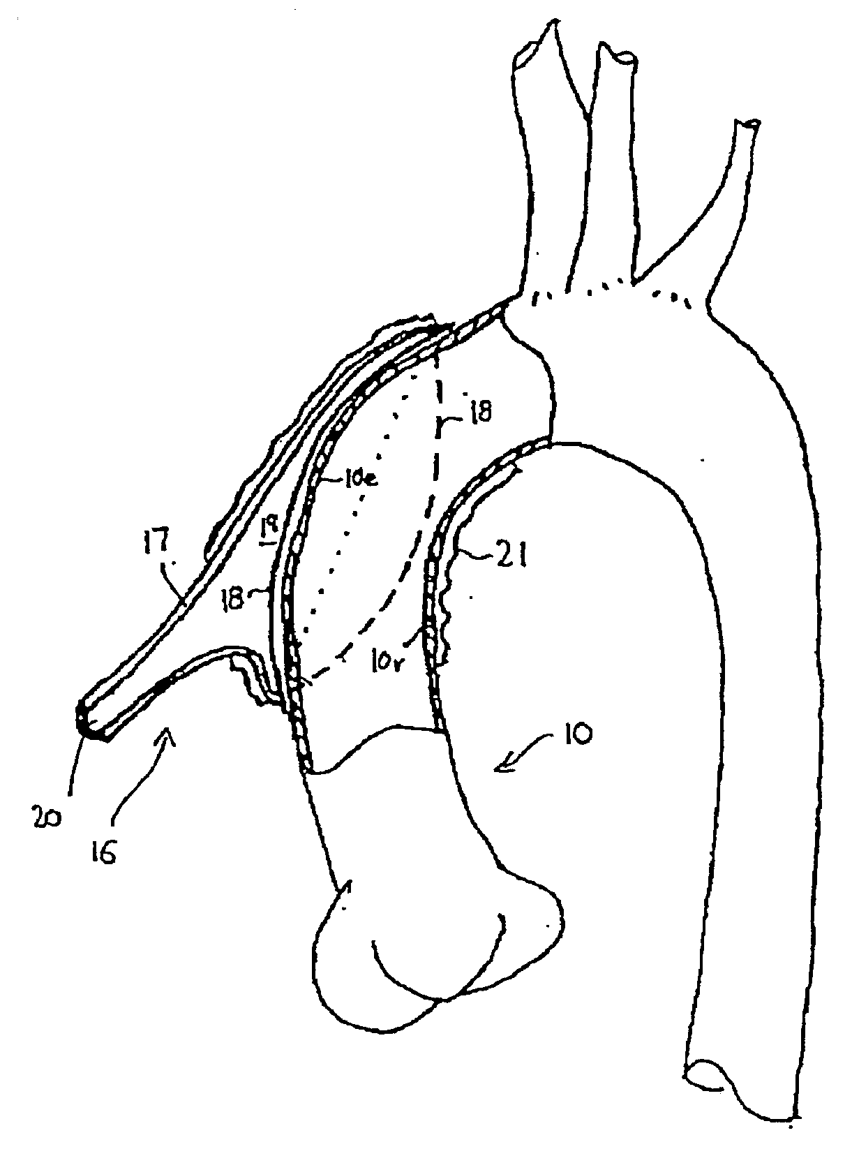 Heart Assist Device Utilising Aortic Deformation