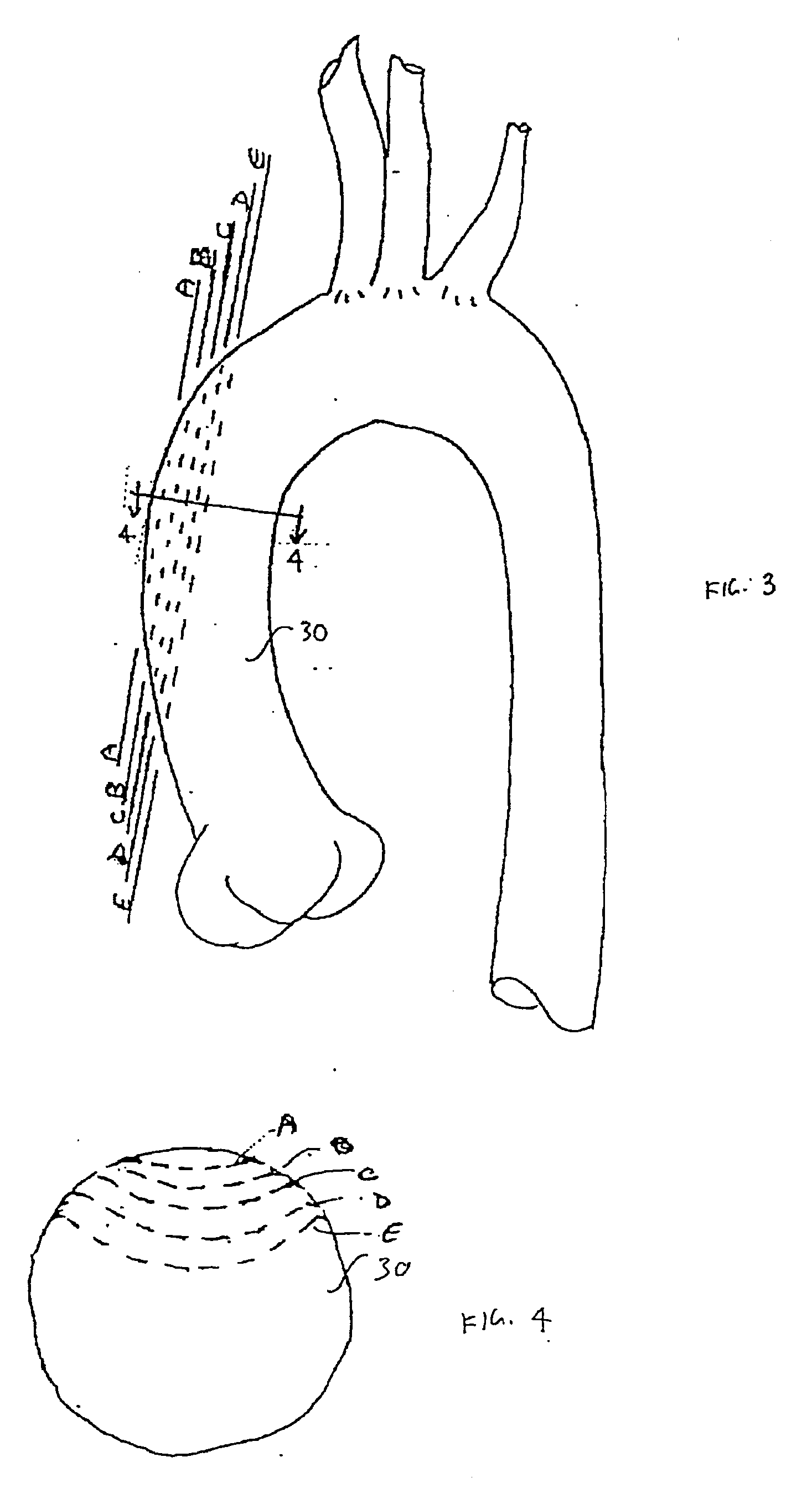 Heart Assist Device Utilising Aortic Deformation