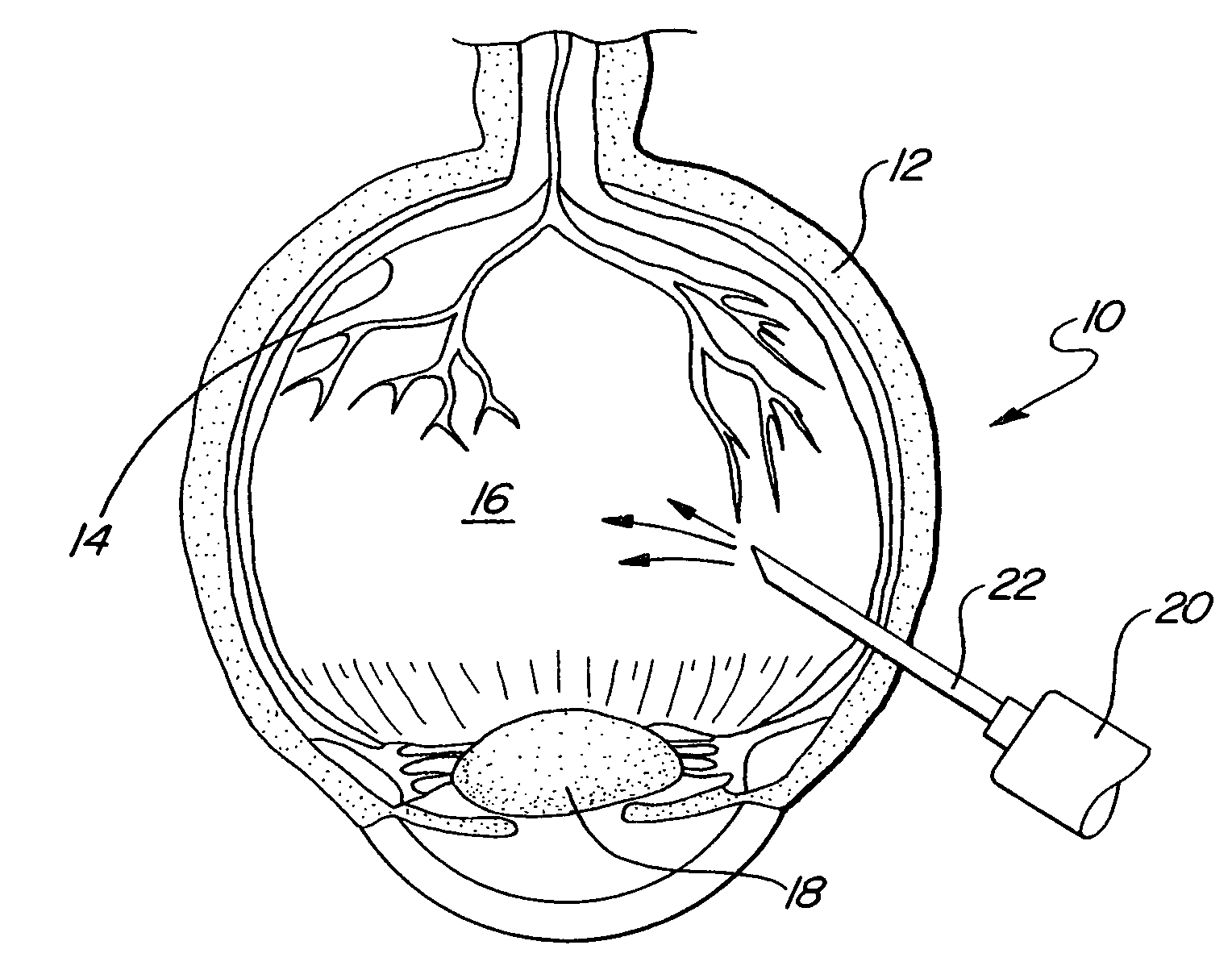 Method for creating a separation of posterior cortical vitreous from the retina of the eye