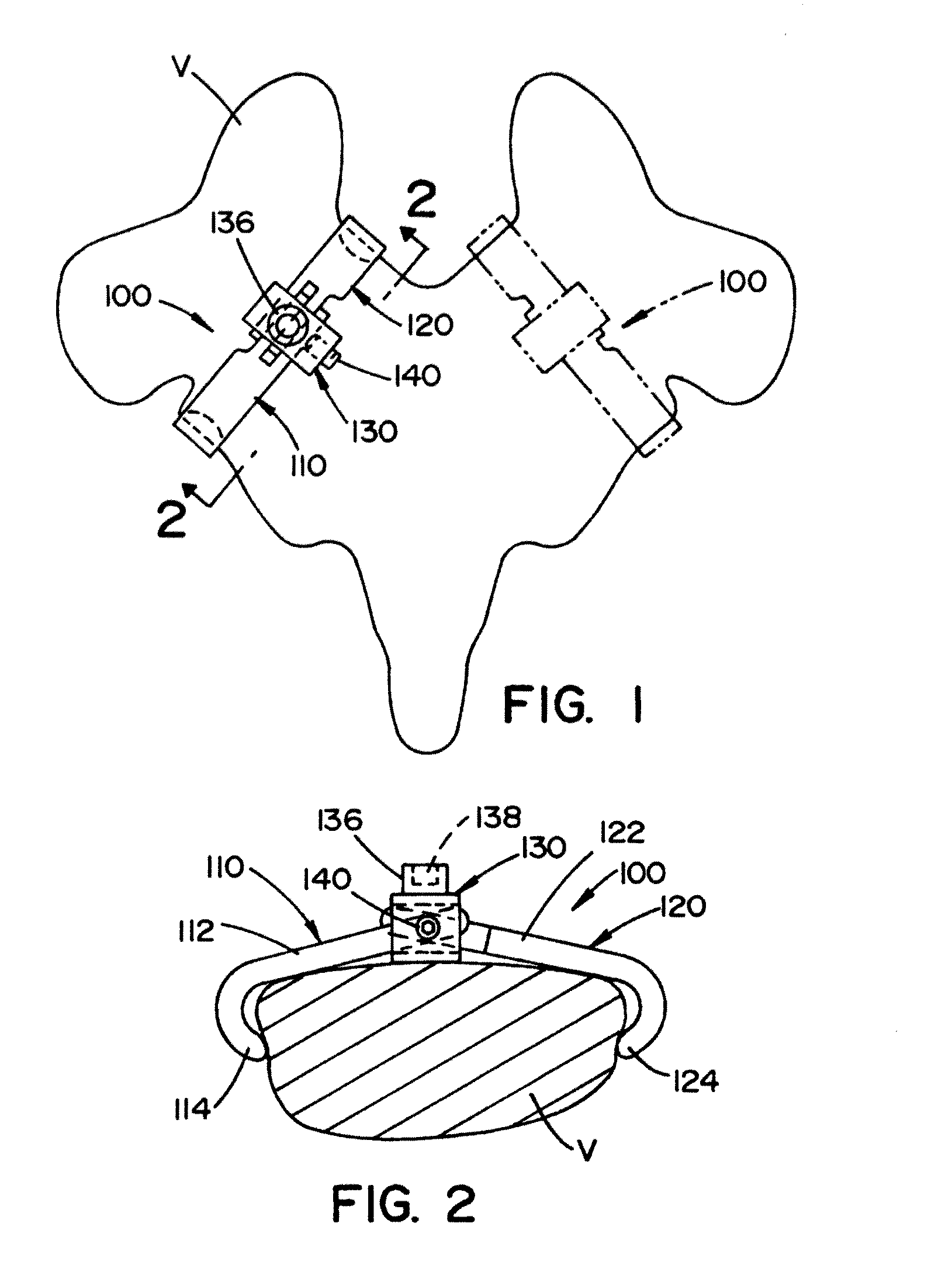 Vertebral pars interarticularis clamp a new spine fixation device, instrumentation, and methodology