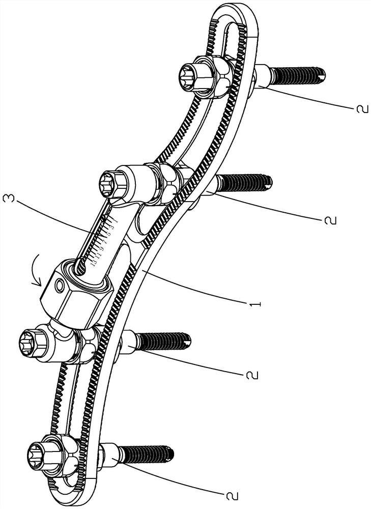 Clavicle fracture percutaneous reduction distraction pressurization fixing device