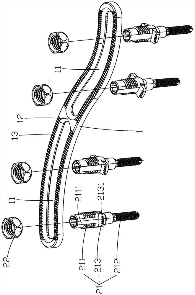 Clavicle fracture percutaneous reduction distraction pressurization fixing device