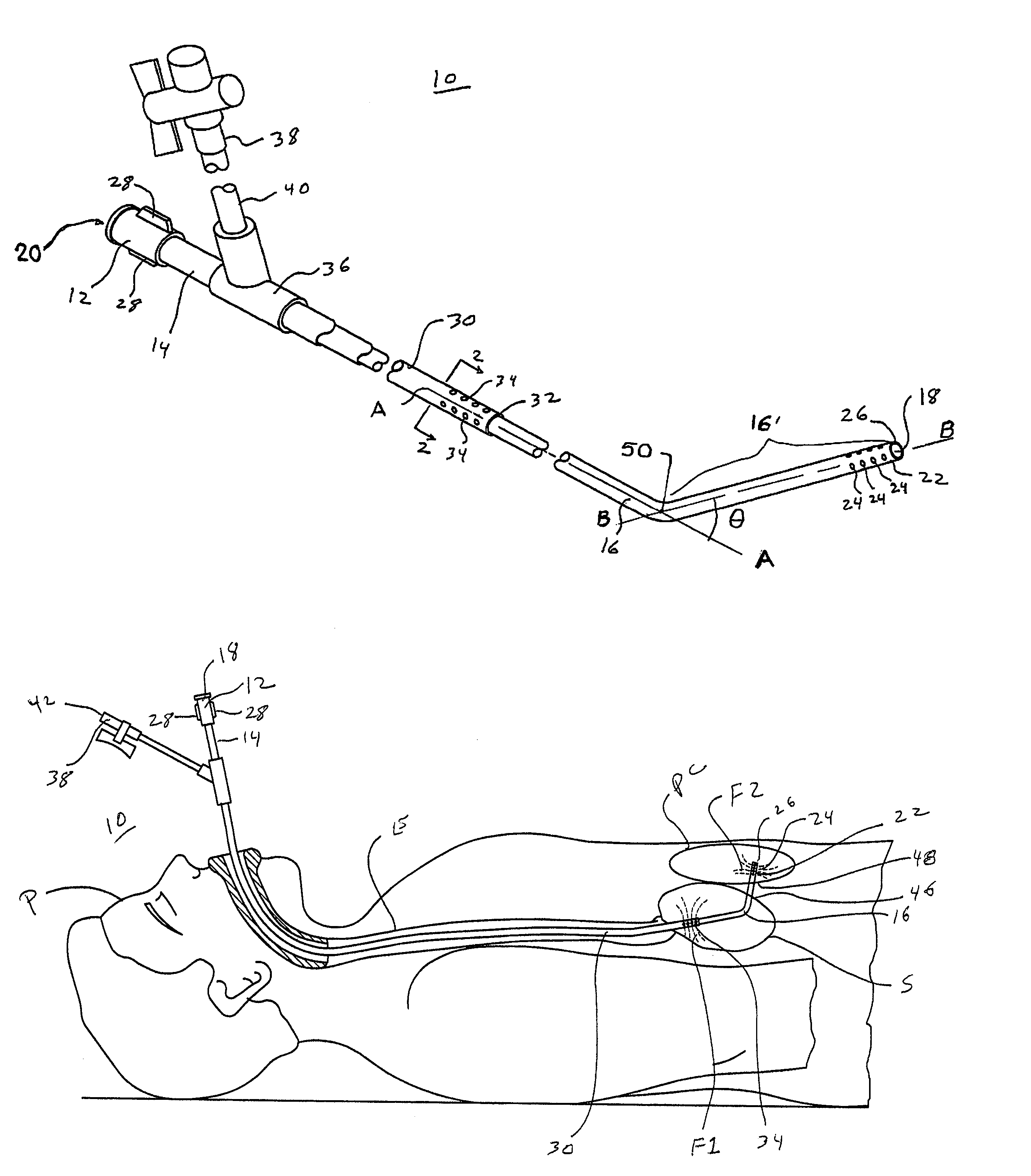 Dual lumen catheter and method for minimally invasive endoluminal surgery