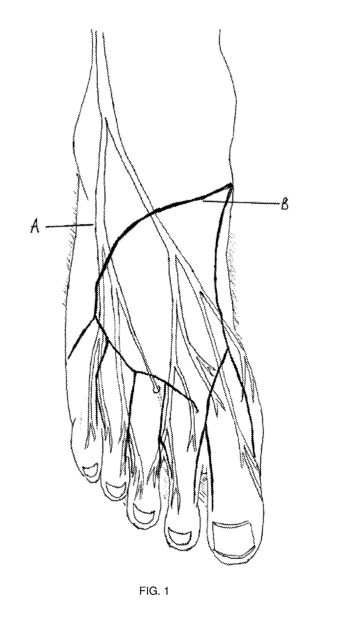 Methods And Compositions For Treating Foot Or Hand Pain