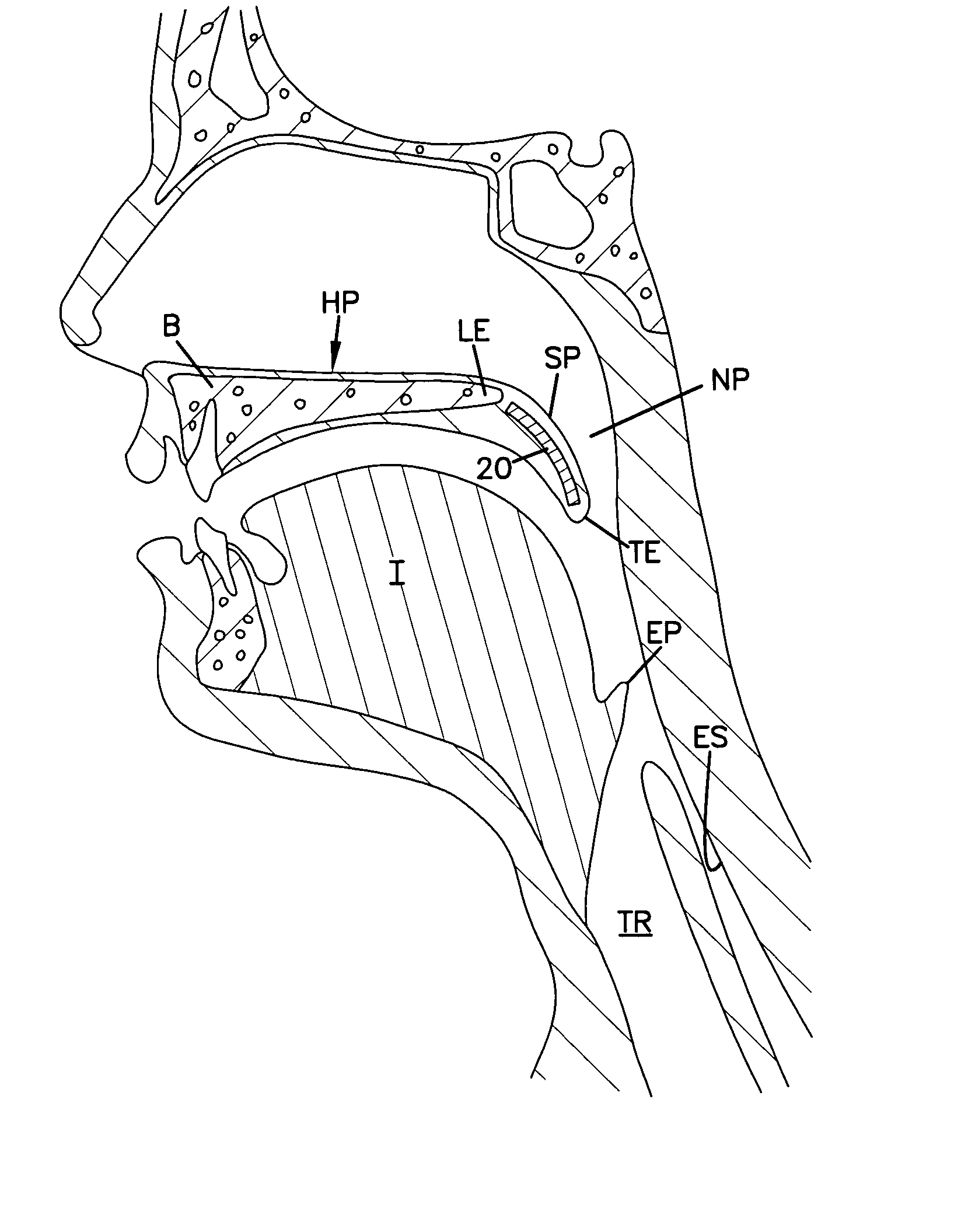 Airway implant and delivery tool and kit