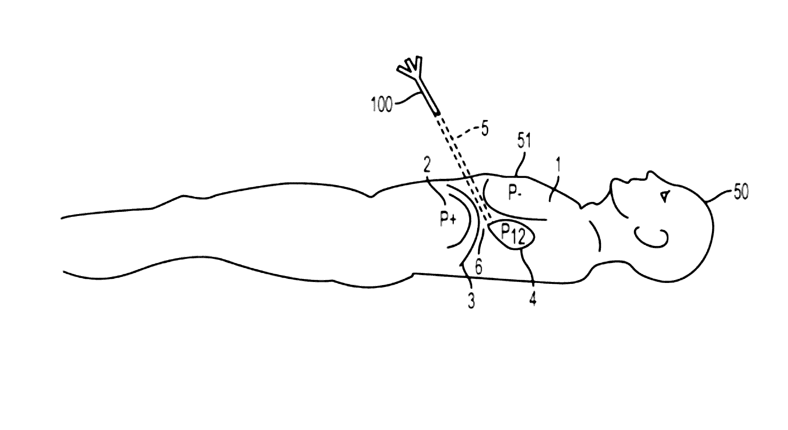 Systems and methods for determining location of an access needle in a subject