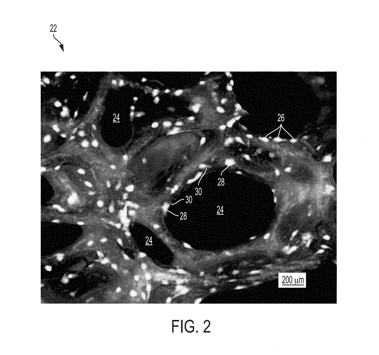 Treatment of skeletal voids with implantable substrate hydrated with bone marrow concentrate