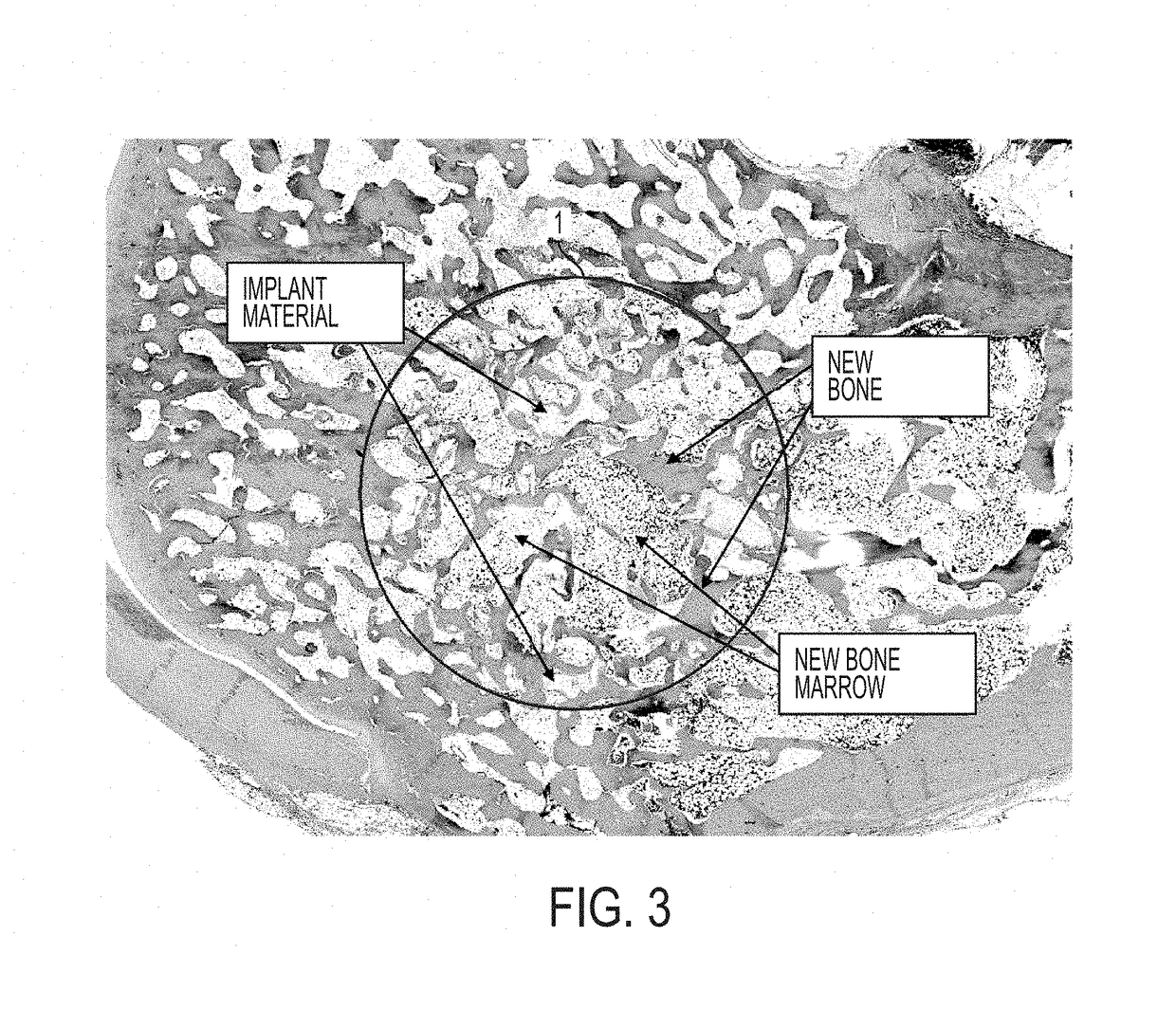 Treatment of skeletal voids with implantable substrate hydrated with bone marrow concentrate