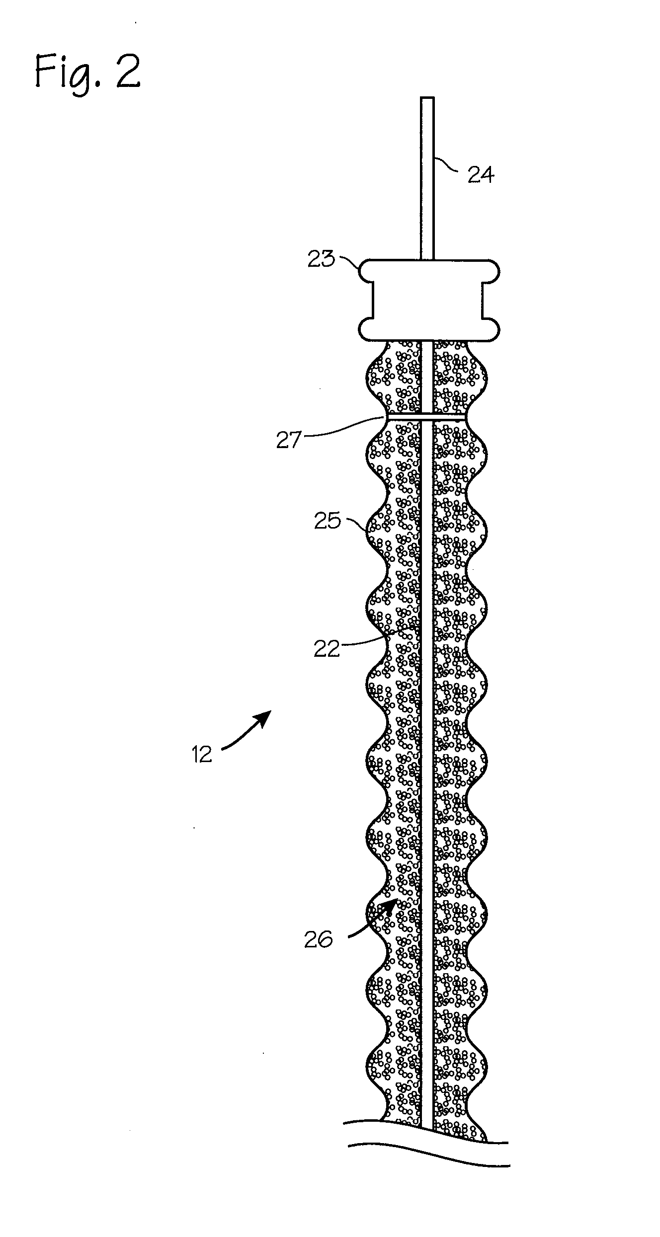 Low Pressure Liquid Nitrogen Cryosurgical System