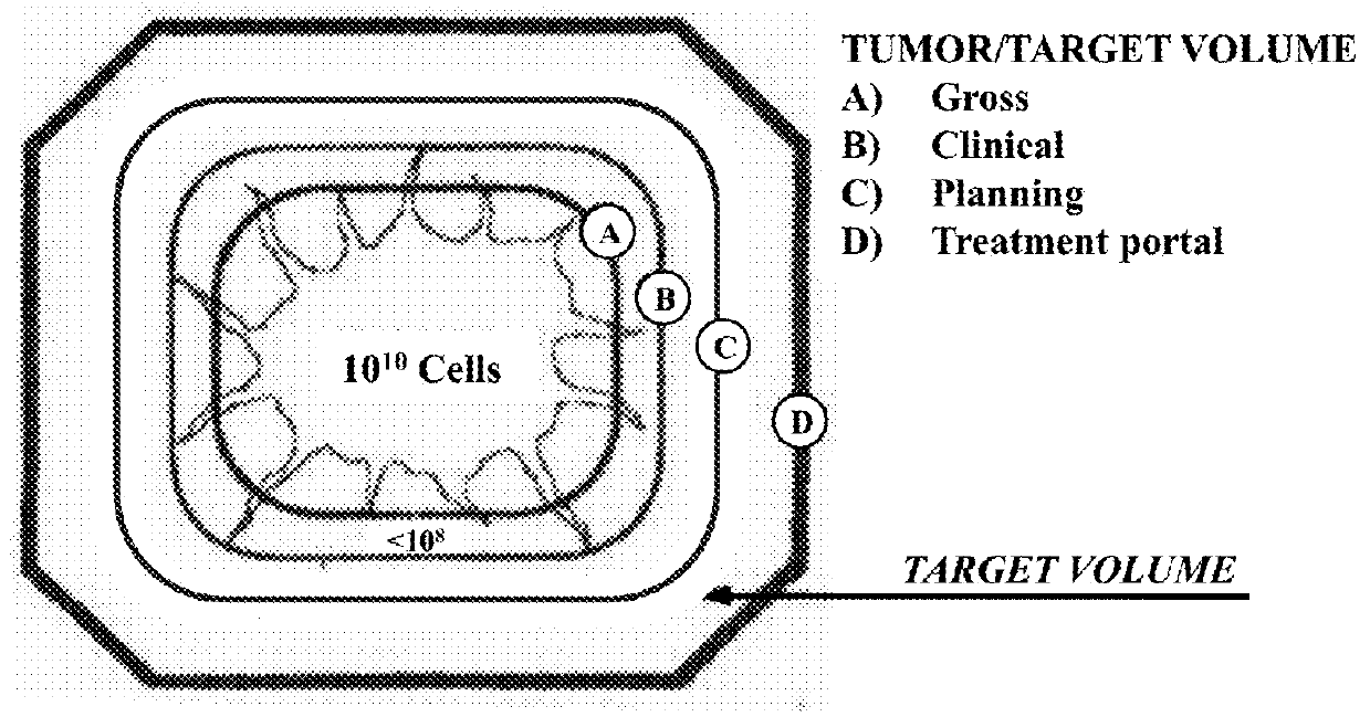 Image-Guided Radiotherapy For Internal Tumor Boost