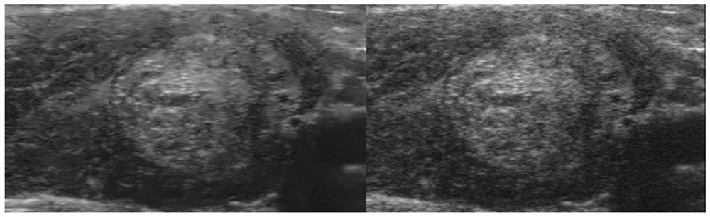 Thyroid nodule automatic grading method and system