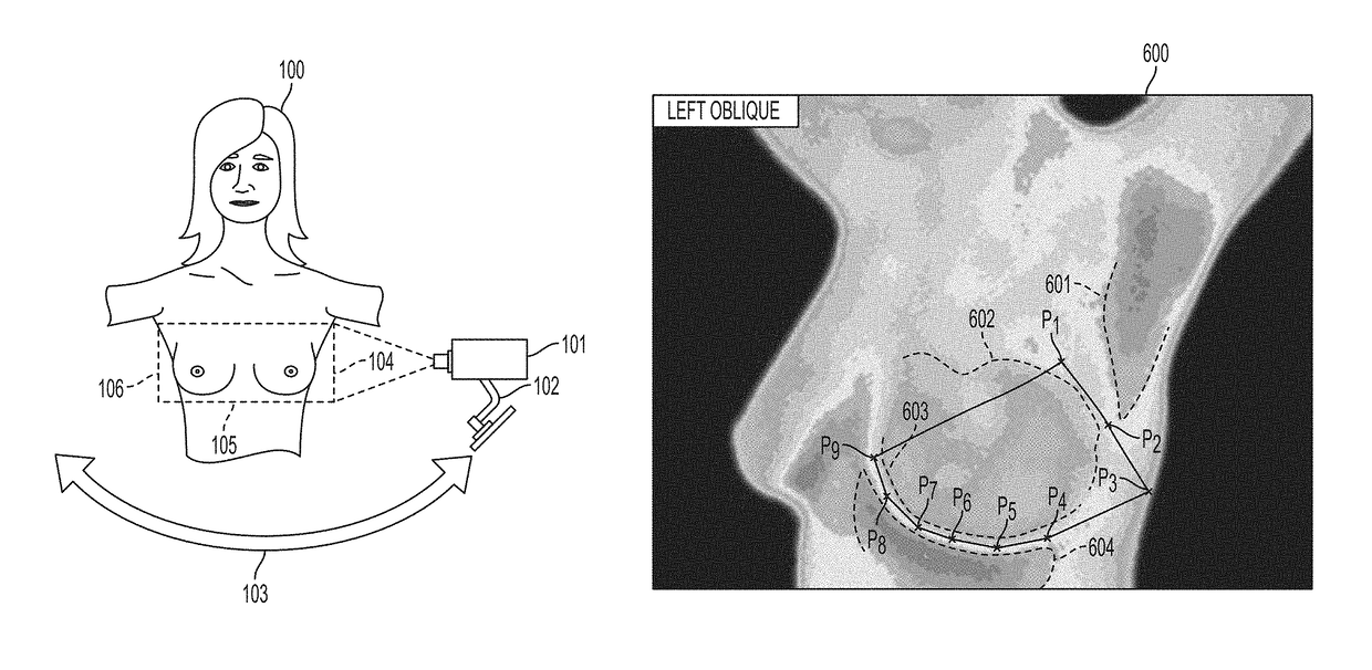 Automatic segmentation of breast tissue in a thermographic image