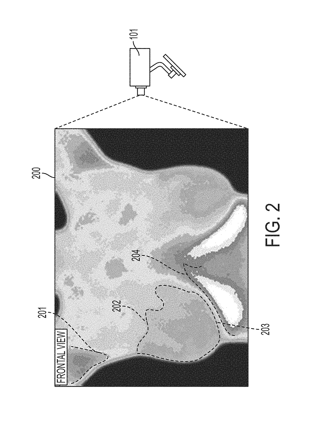 Automatic segmentation of breast tissue in a thermographic image