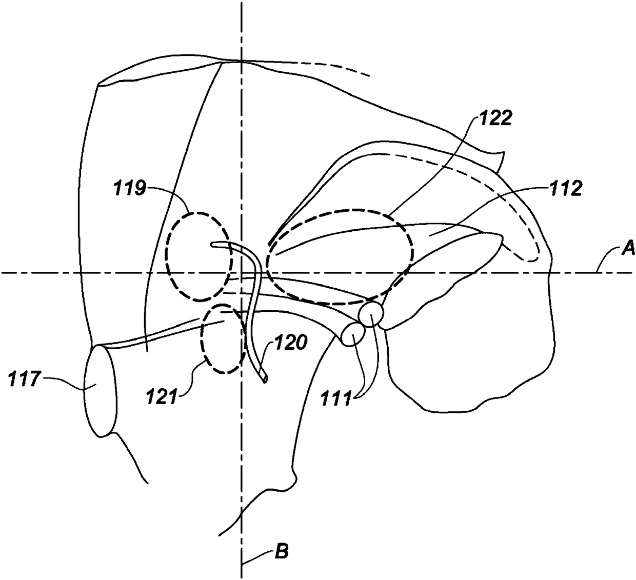 Prosthesis for inguinal hernia repair