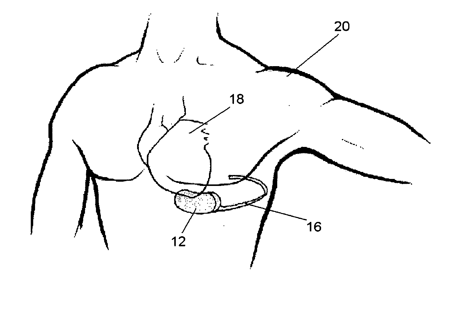 Subcutaneous cardioverter-defibrillator