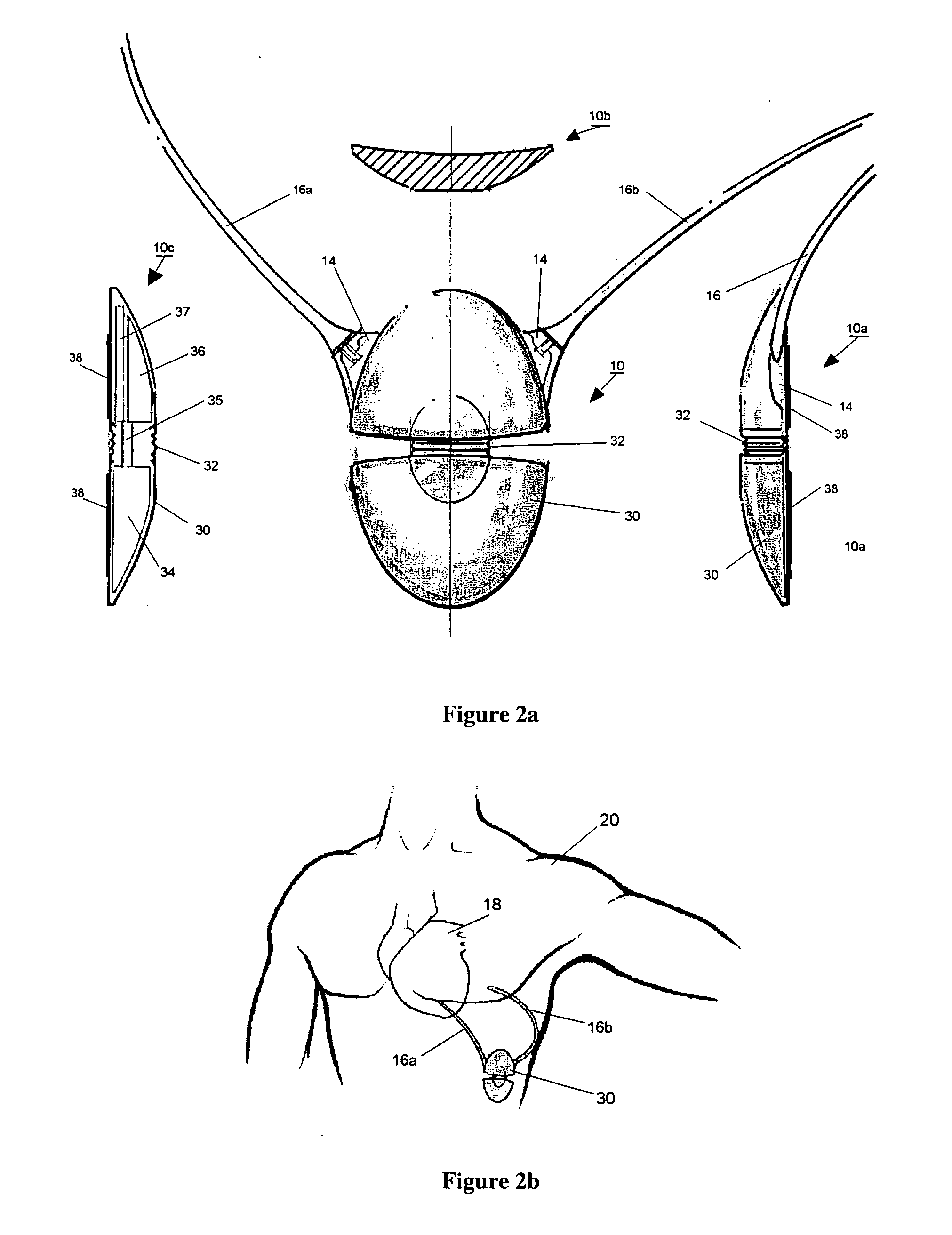 Subcutaneous cardioverter-defibrillator