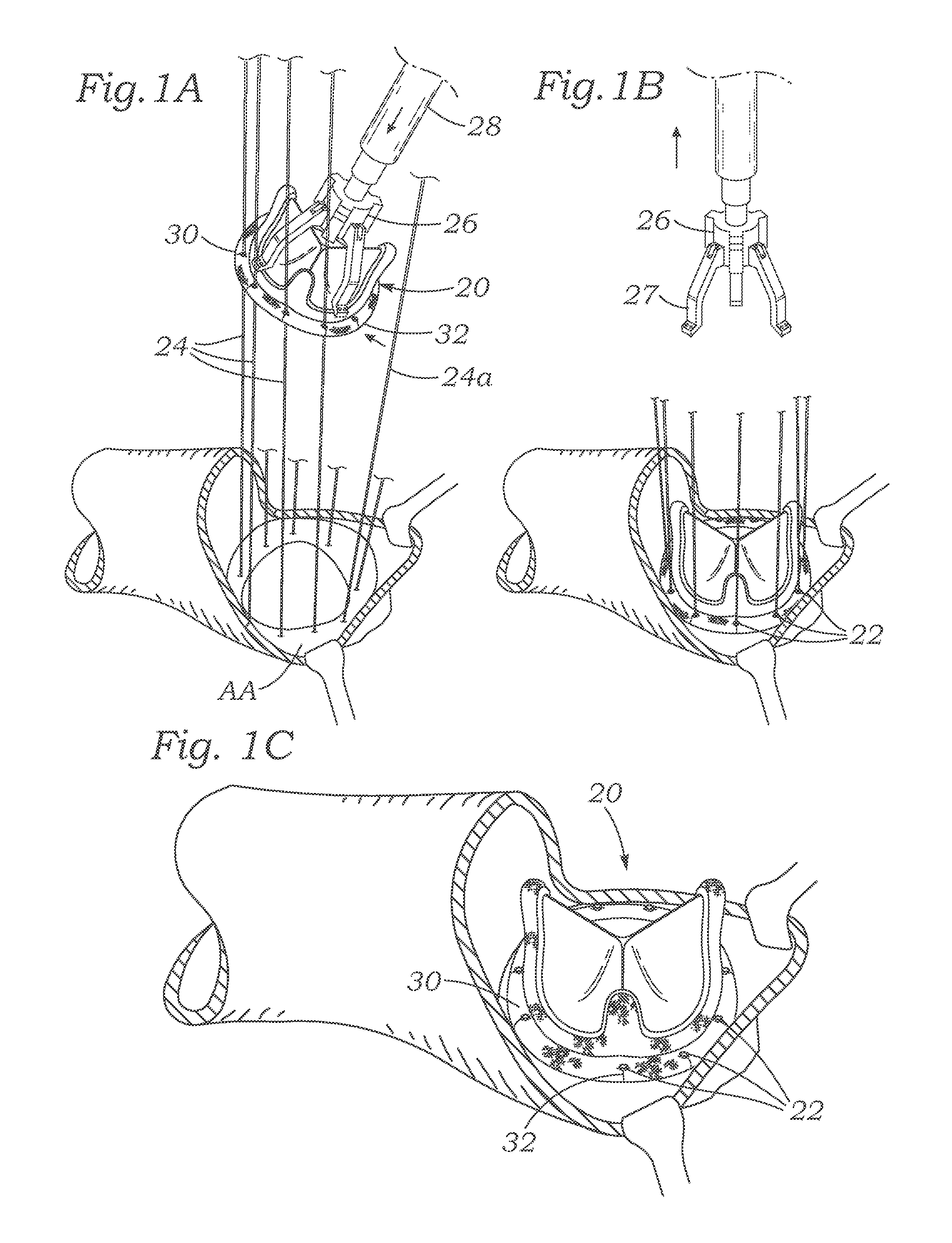 Cardiac implant with integrated suture fasteners