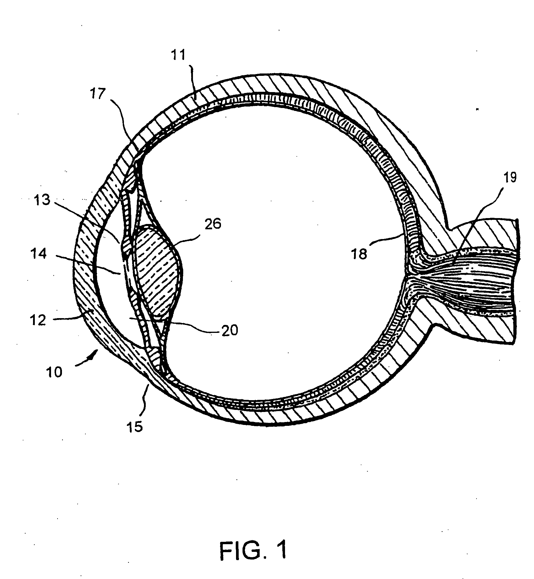 Fluid infusion methods for glaucoma treatment