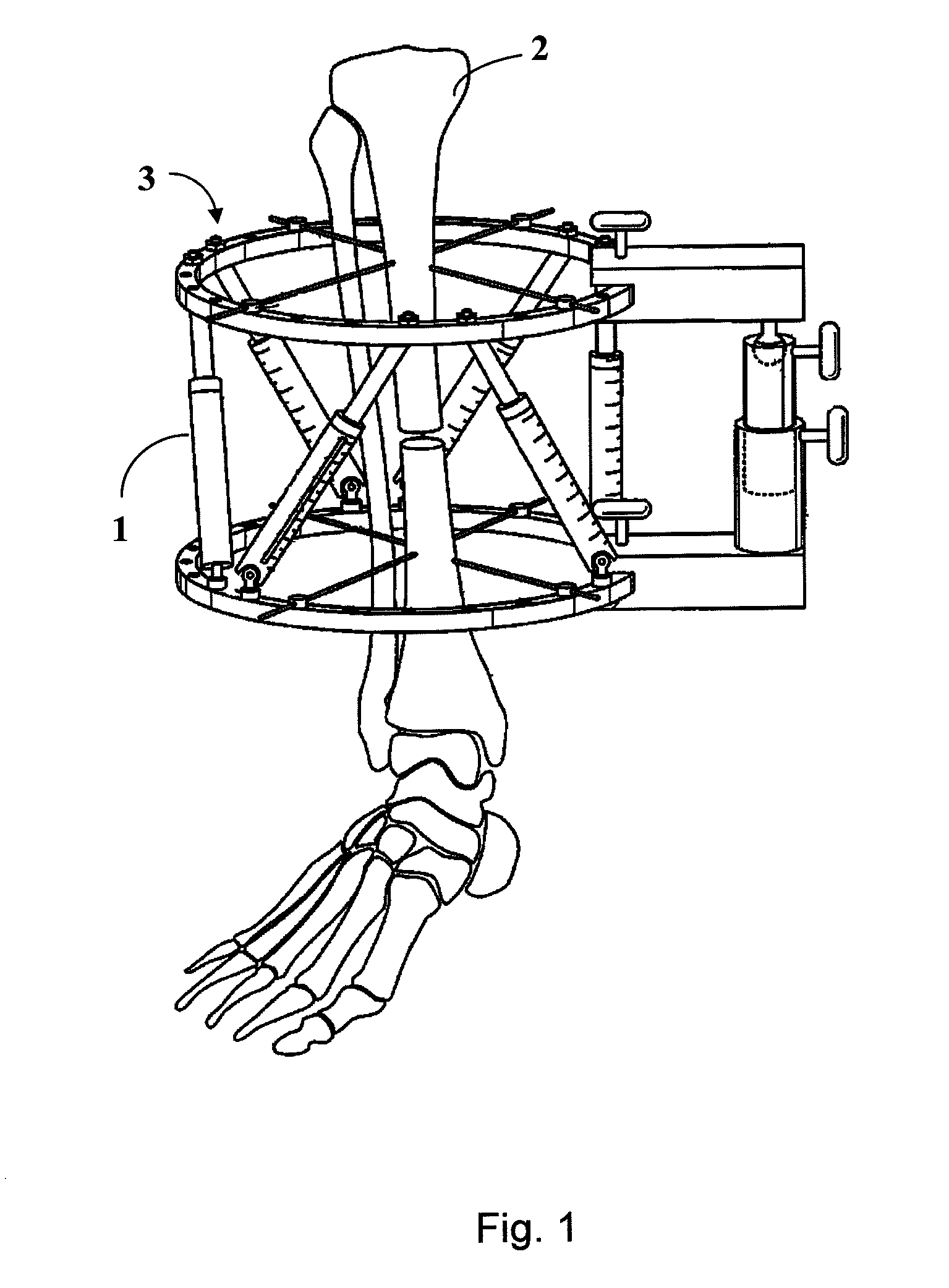 Multiple axes external bone fixing member