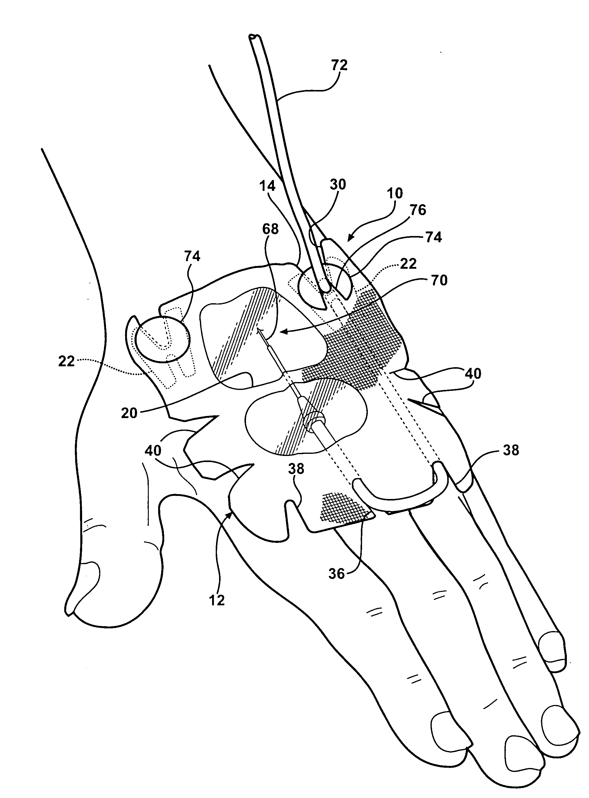 PIV dressing assembly