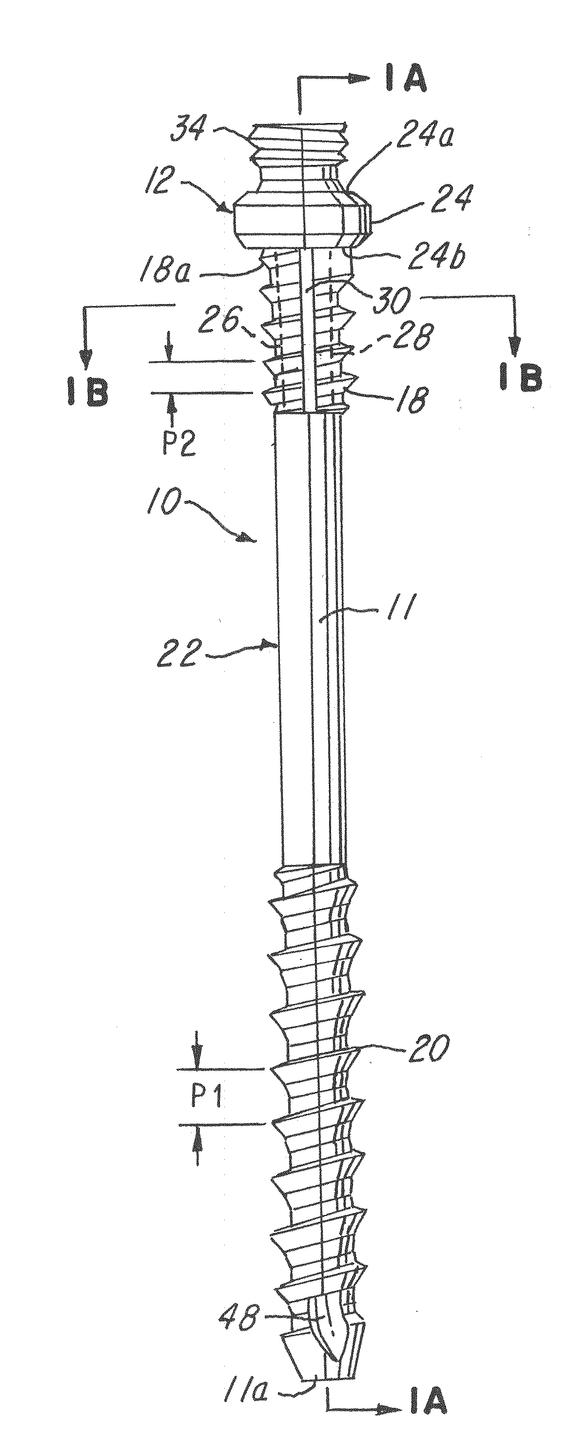 Spinal facet compression screw with variable pitch thread zones and buttress head