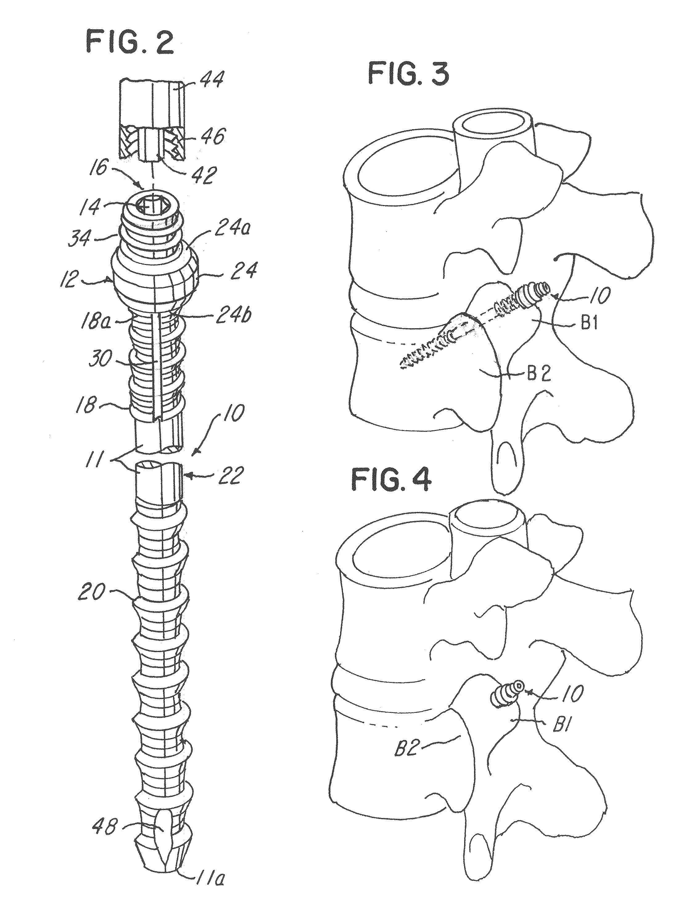 Spinal facet compression screw with variable pitch thread zones and buttress head