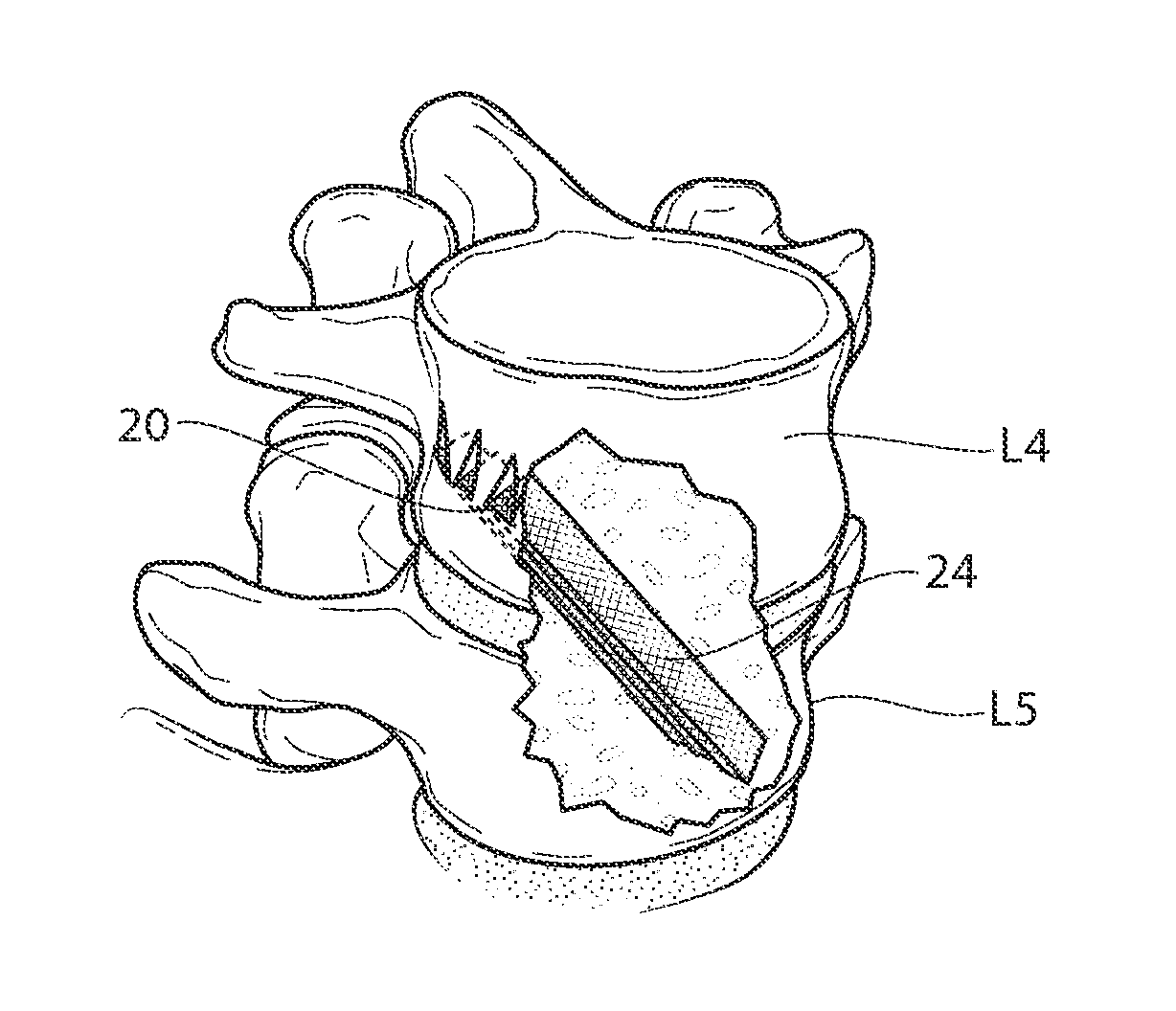 Apparatus, systems, and methods for achieving lumbar facet fusion