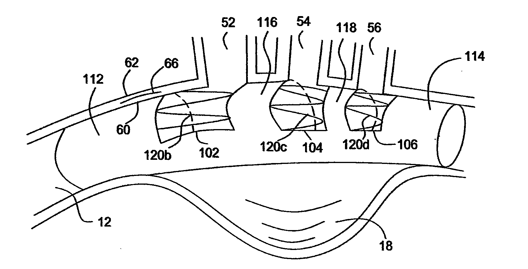 Methods and Apparatus for Treatment of Thoracic Aortic Aneurysms