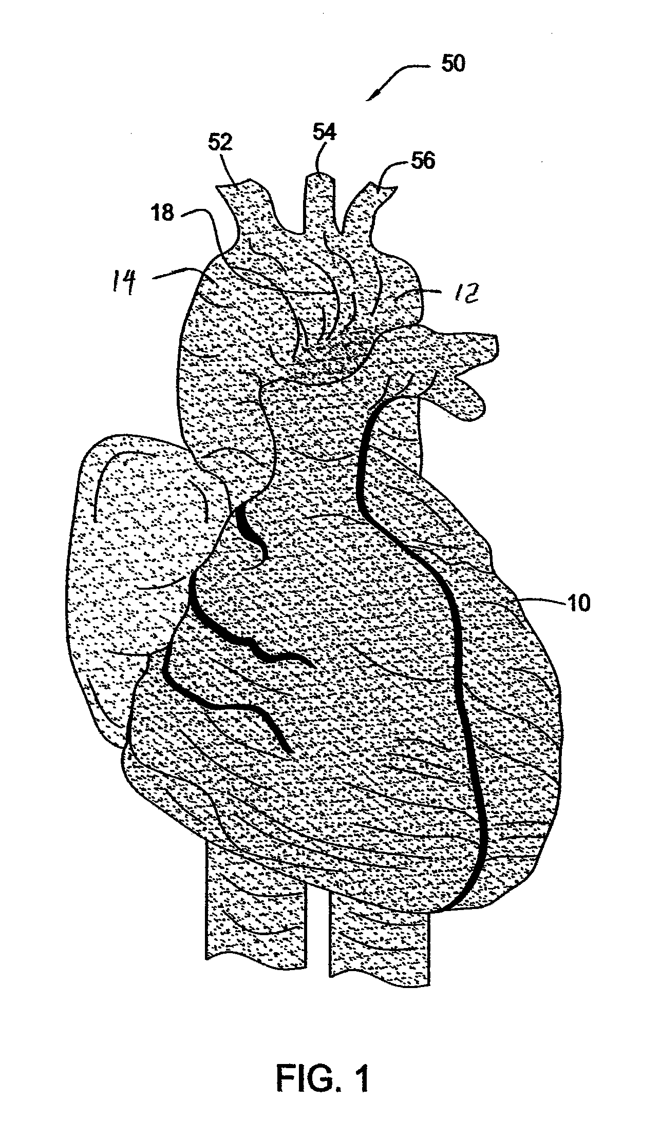 Methods and Apparatus for Treatment of Thoracic Aortic Aneurysms