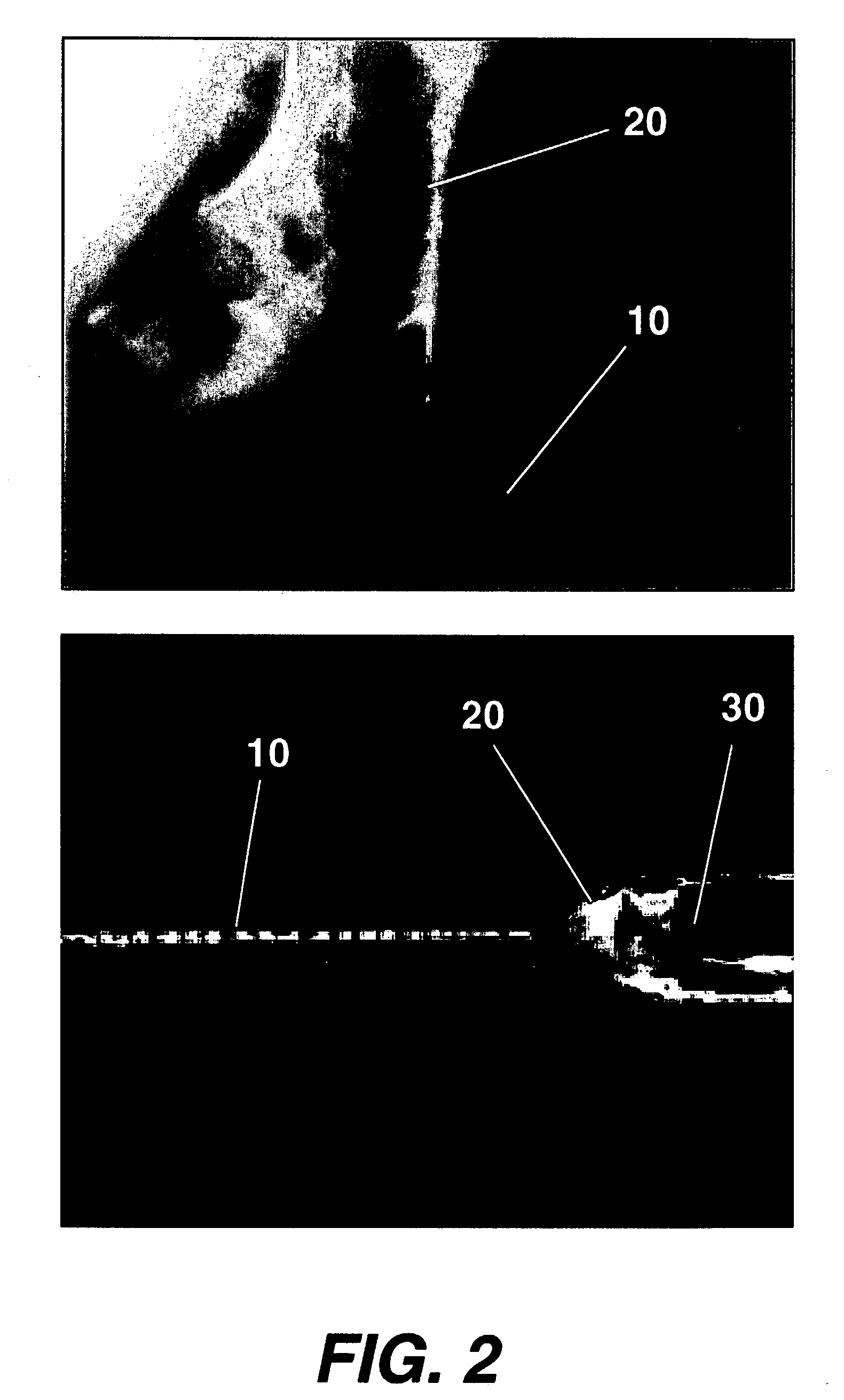 Method for stromal corneal repair and refractive alteration