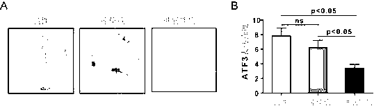 Application of ATF (activating transcription factor) 3 to predicting bladder cancer metastasis and judging prognosis