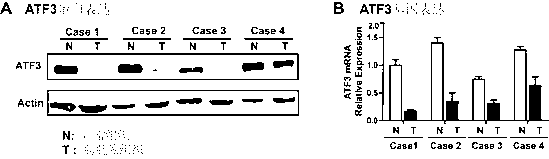 Application of ATF (activating transcription factor) 3 to predicting bladder cancer metastasis and judging prognosis