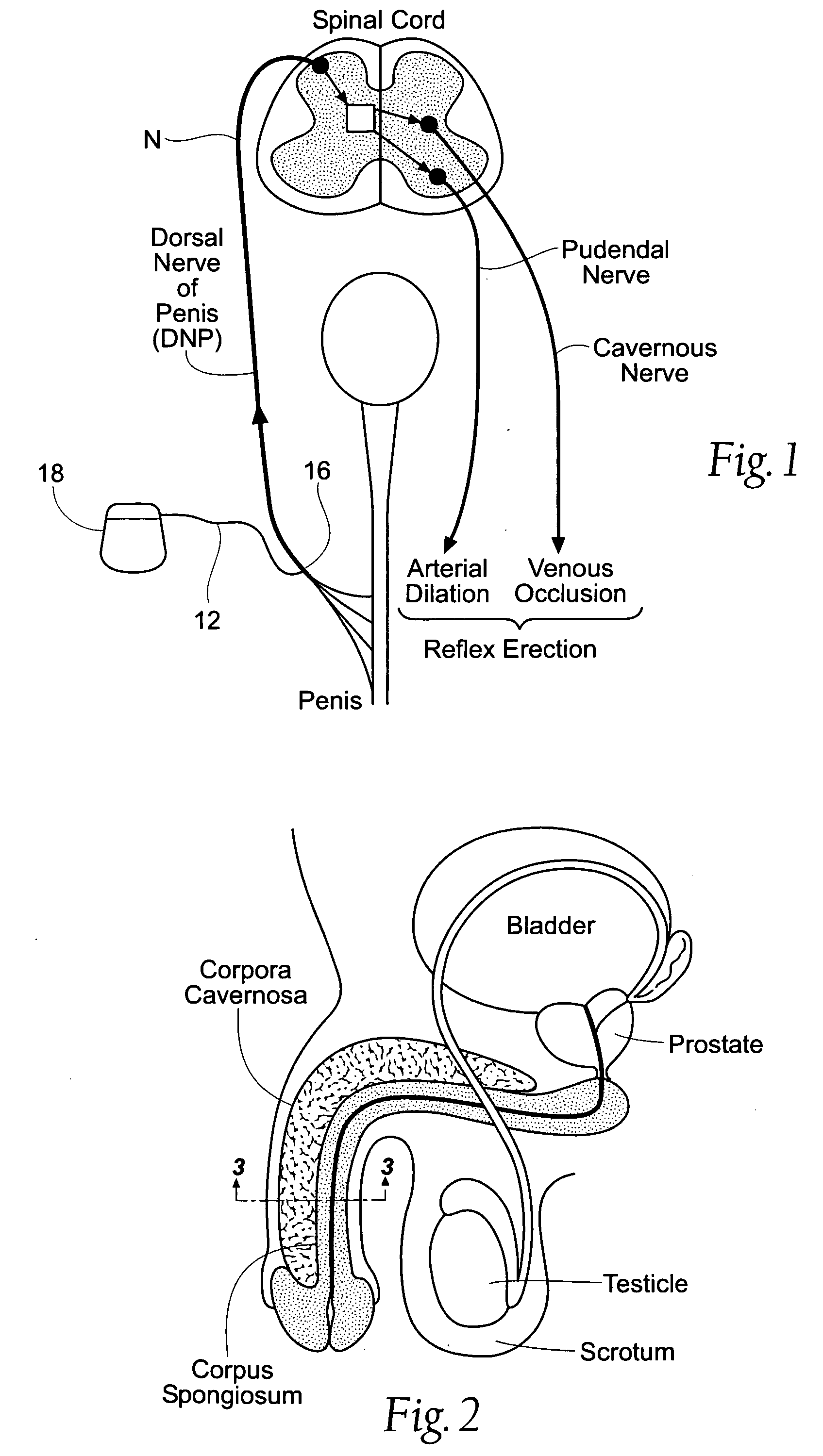 Systems for electrical stimulation of nerves in adipose tissue regions