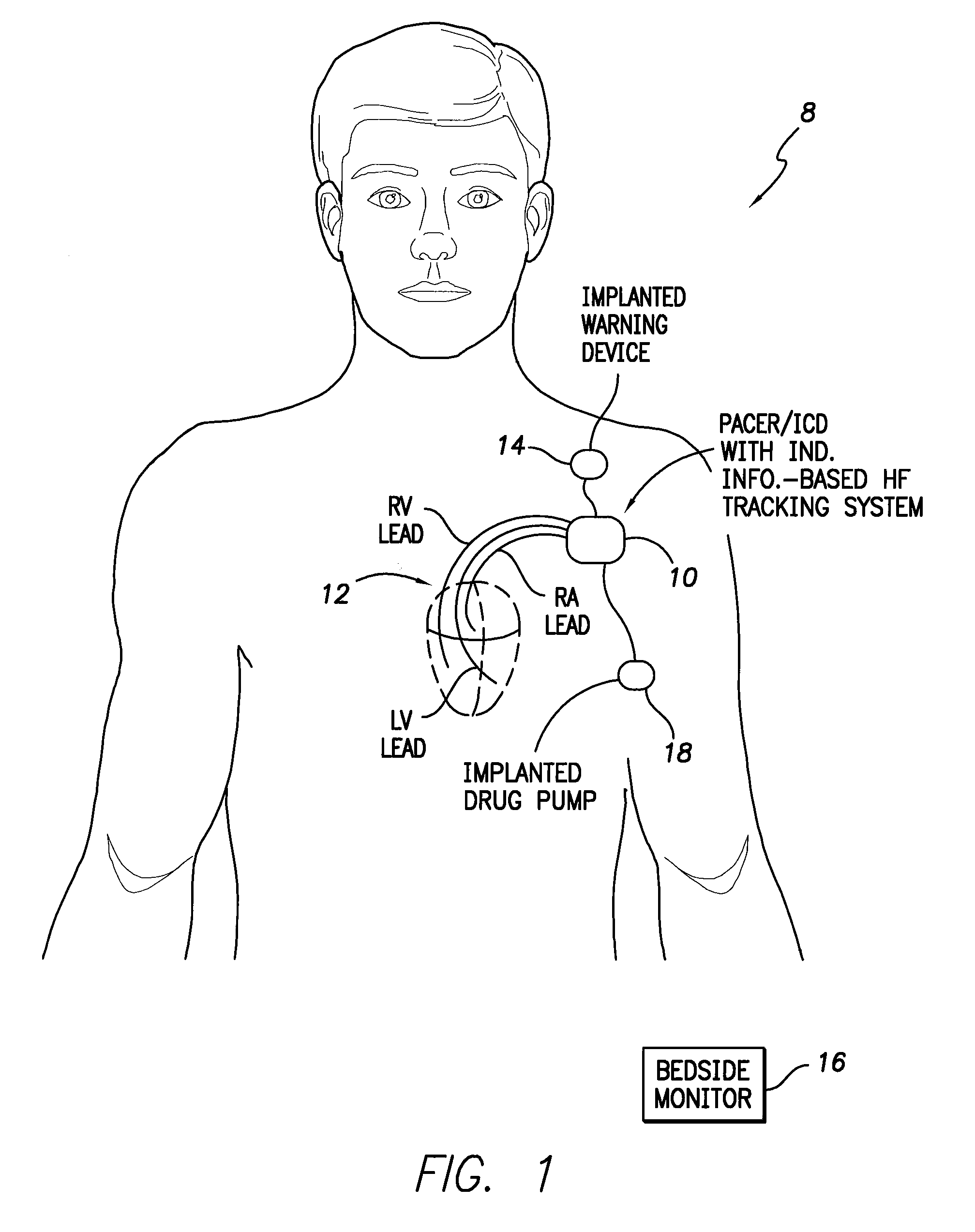 Systems and methods for use by an implantable medical device for detecting heart failure based on the independent information content of immitance vectors