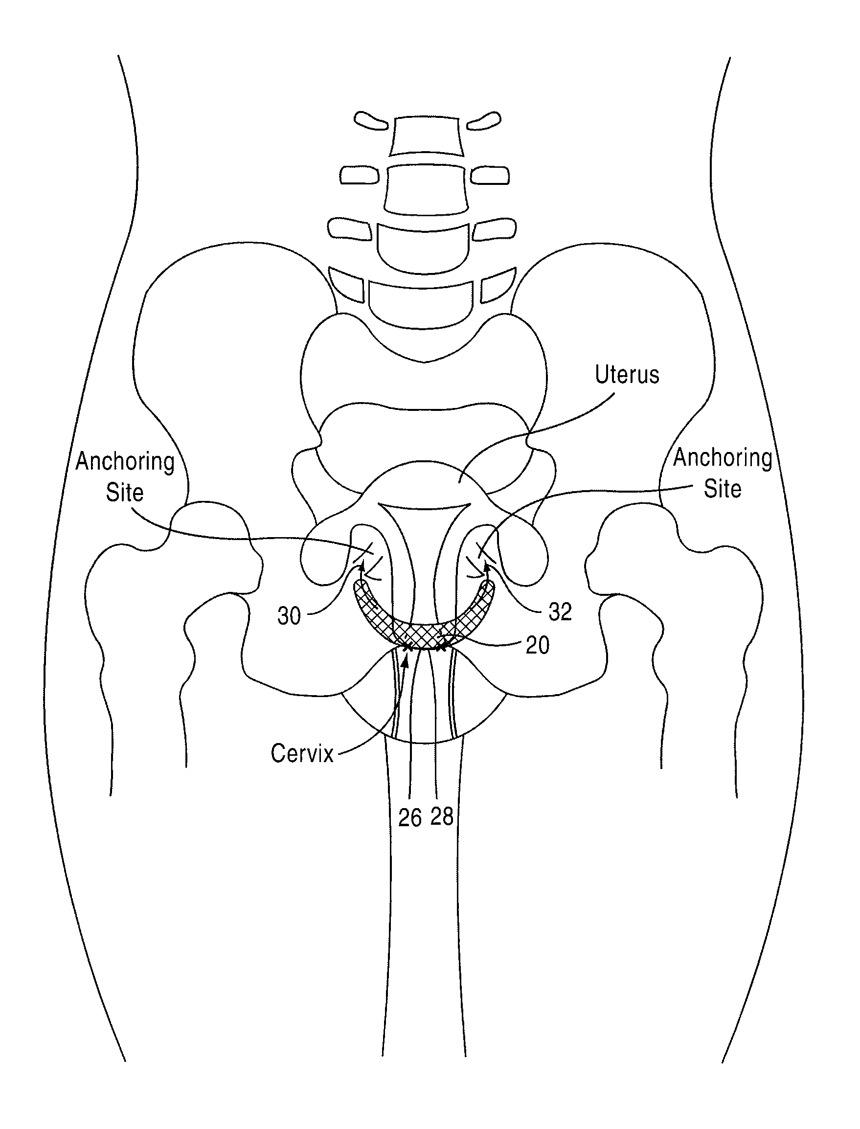 Apparatus and method for suspending a uterus