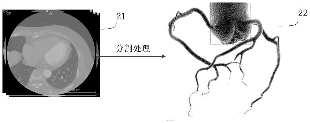 Method and device for detecting coronary calcified plaque