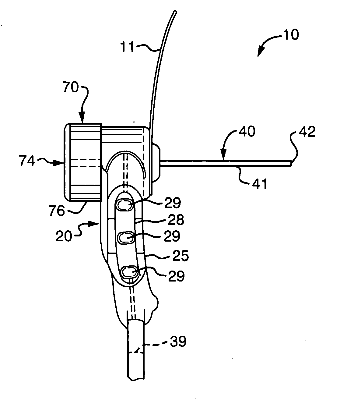 Ductal lavage microcatheter with user activated valve and Nitinol introducer