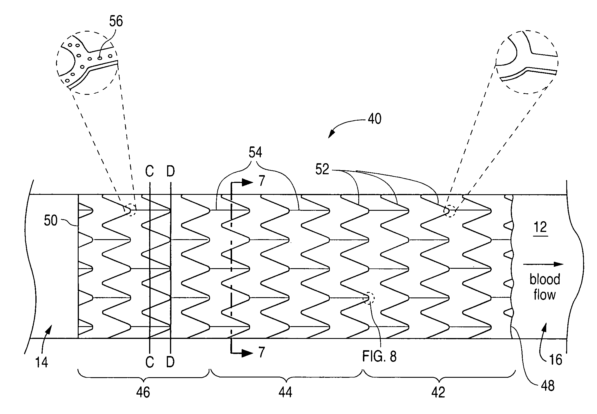 Stent with drug coating