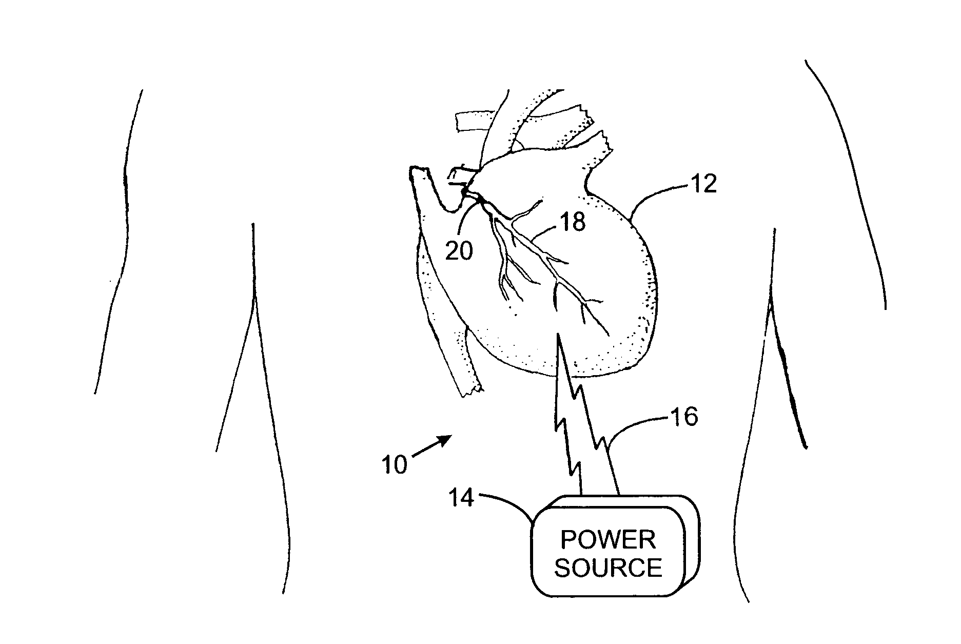 Medical Device With Intra-Conductor Capacitive Energy Storage