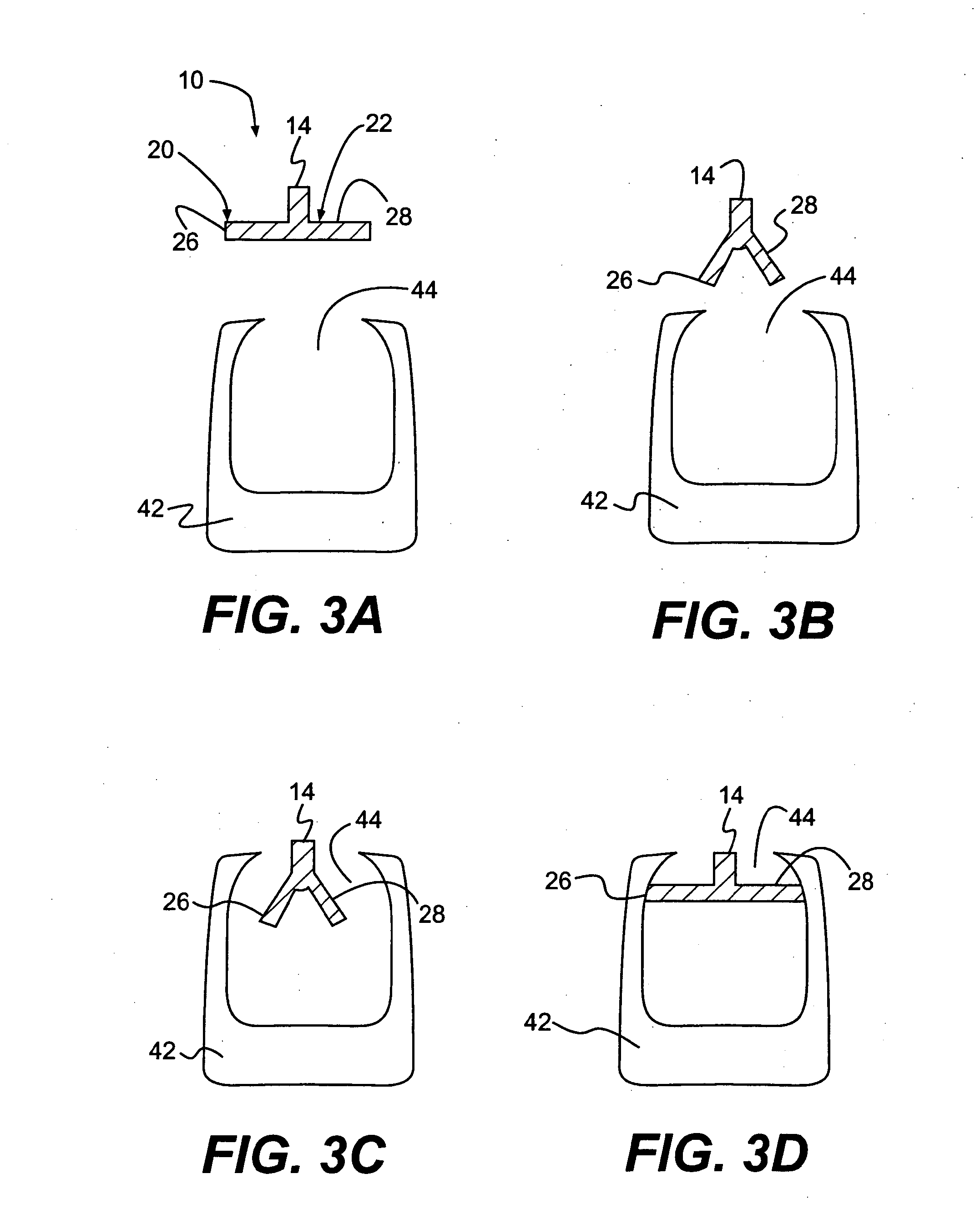 Method and Apparatus for Enhanced Delivery of Treatment Device to the Intervertebral Disc Annulus