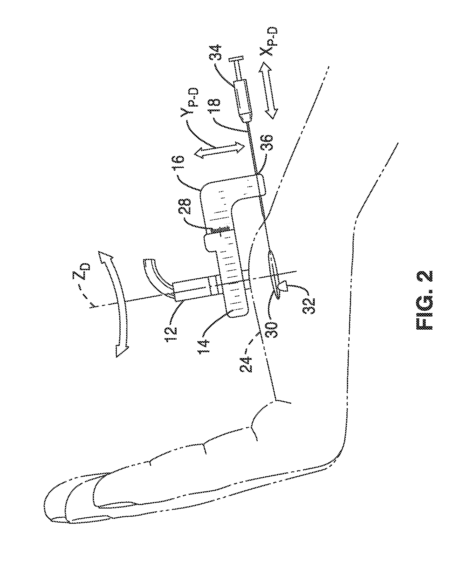 Treatment of carpal tunnel syndrome by injection of the flexor retinaculum