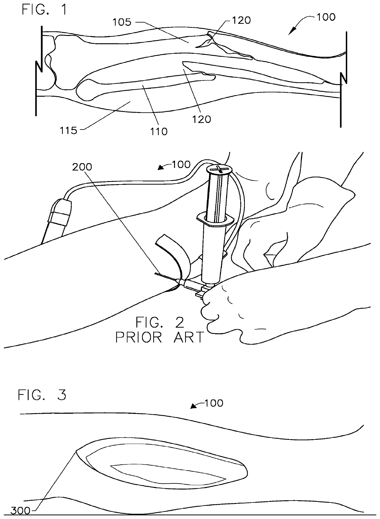 Method and system for monitoring oxygenation levels of a compartment for detecting conditions of a compartment syndrome