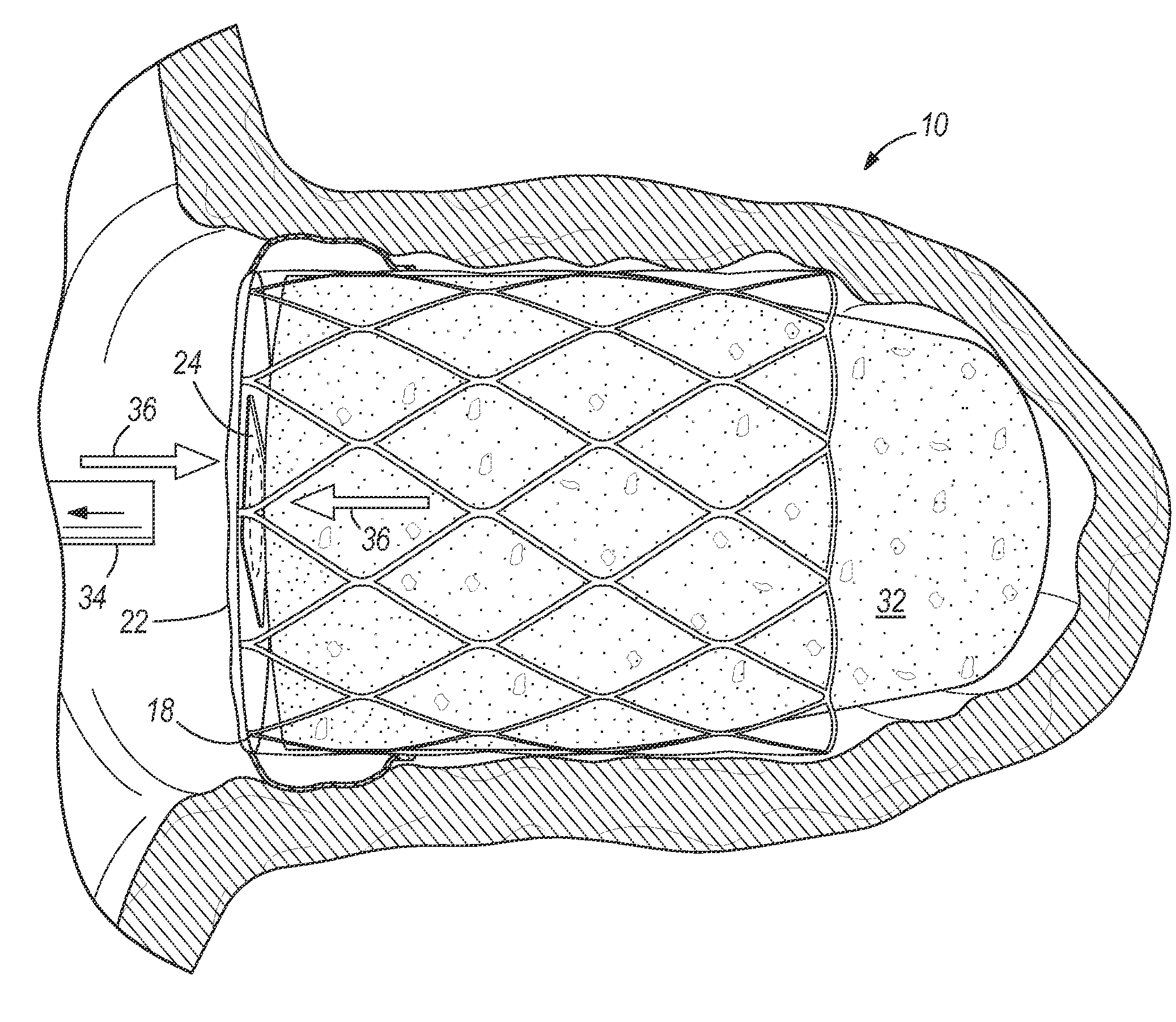 Left atrial appendage occluder