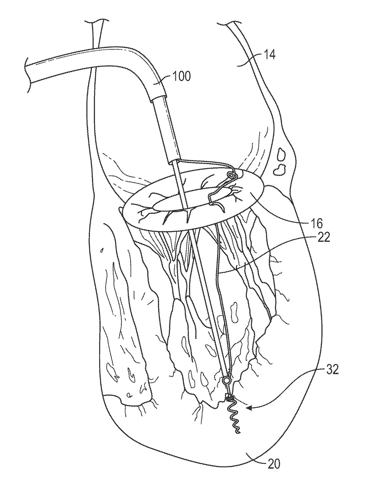 Method and apparatus for transvascular implantation of neo chordae tendinae