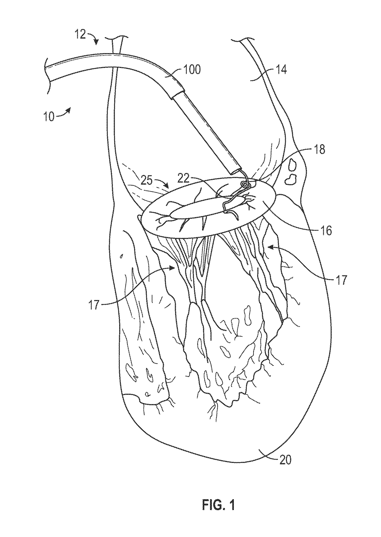 Method and apparatus for transvascular implantation of neo chordae tendinae