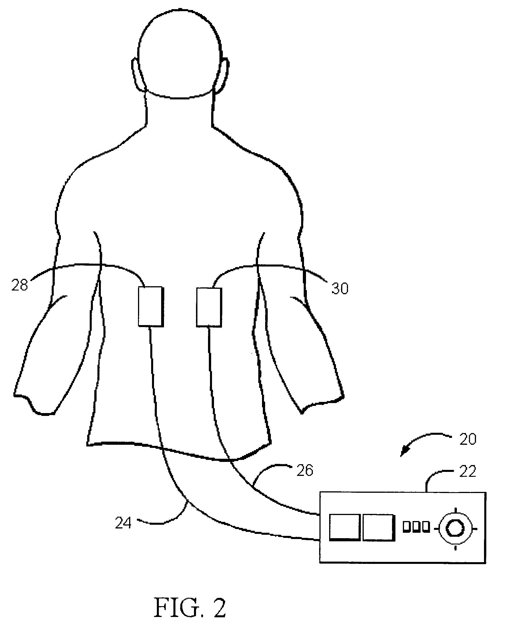 Transcutaneous electrical nerve stimulator for appetite control