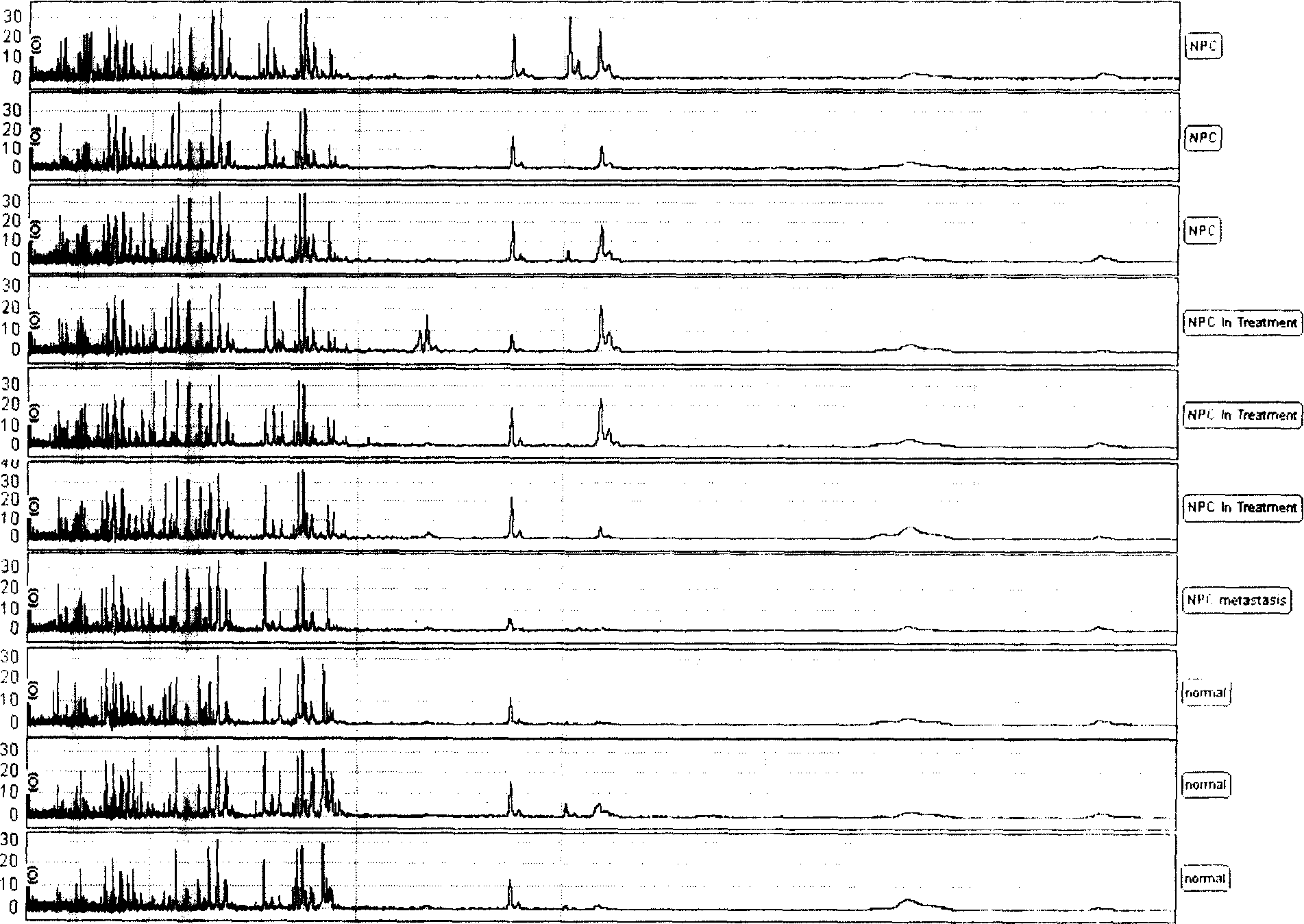 Serum protein fingerprint spectrum method for nasopharyngeal carcinoma detection