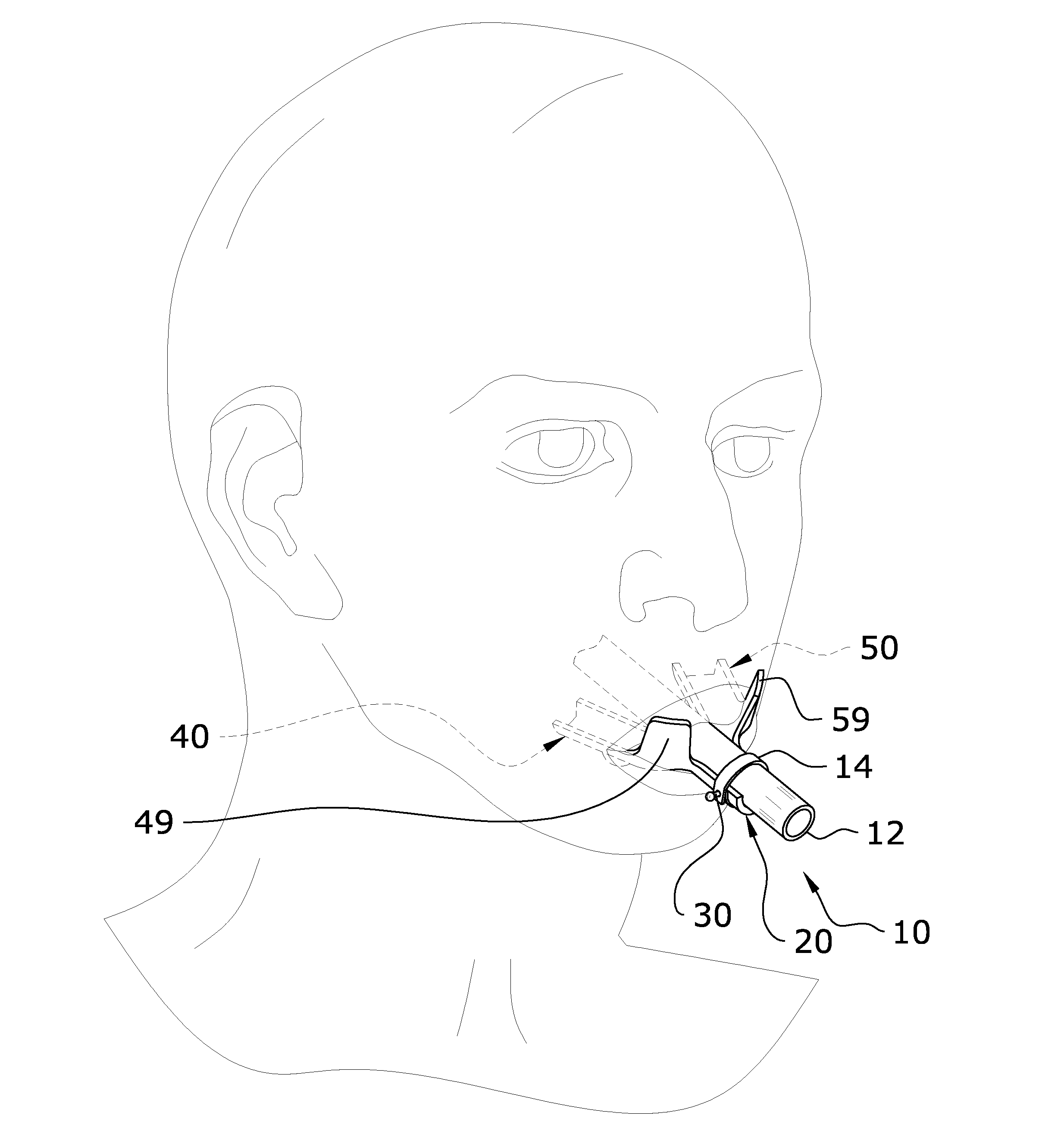 Intubation Tube Oral Appliance System