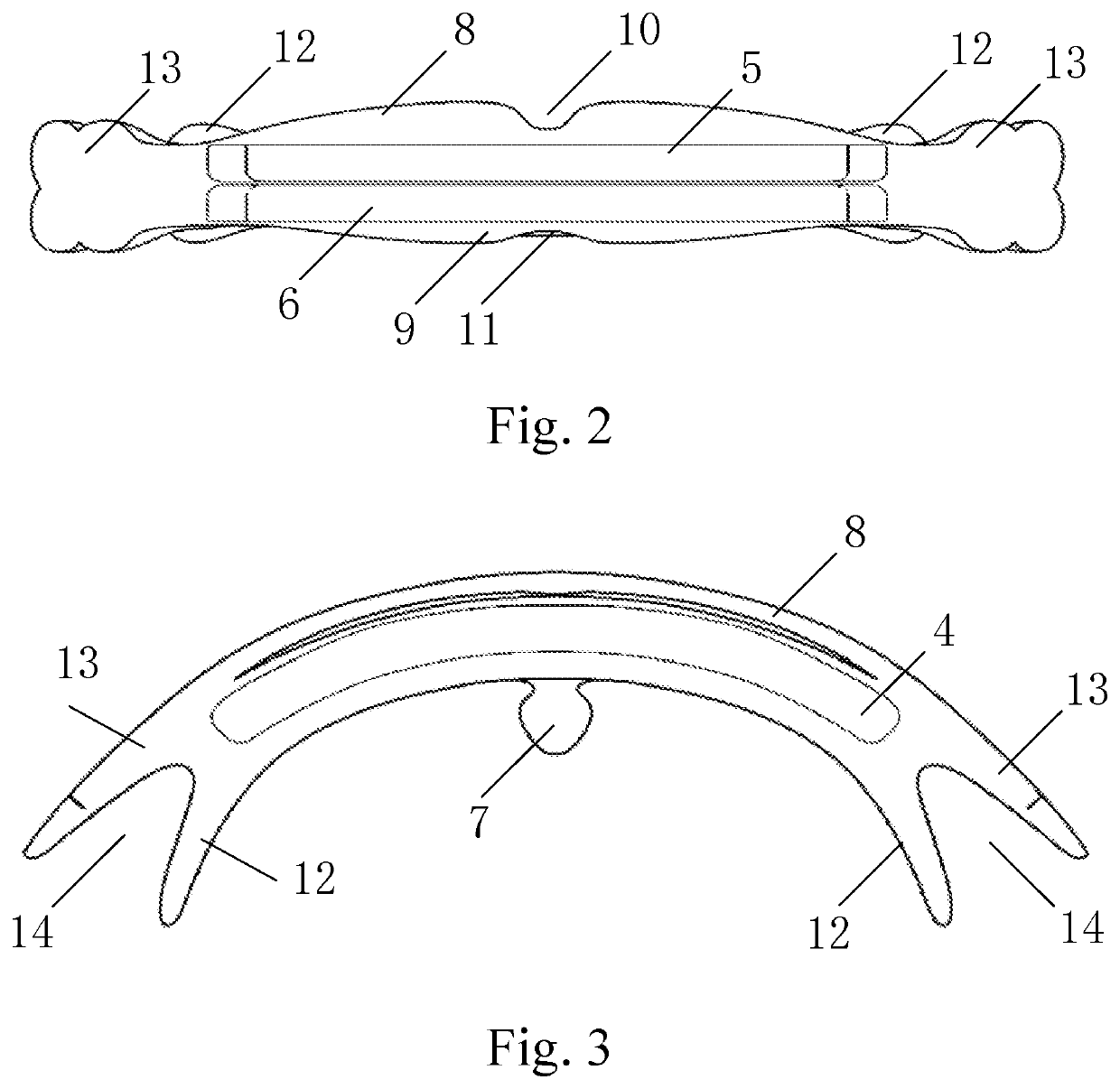 Vocalization appliance for assisting vocal cord closure training